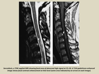 Sarcoidosis, a T2W sagittal MRI showing focal area of abnormal high signal at C5–C6. b T1W gadolinium enhanced
image shows focal contrast enhancement at that level (same area indicated by an arrow on each image).
 