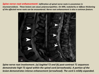 Spine nerve root enhancement: Infiltration of spinal nerve roots is uncommon in
neurosarcoidosis. These lesions can cause polyneuropathies. On MRI, nodularity or diffuse thickening
of the affected nerve roots can be encountered. Nerve root enhancement is also a common feature.
Spine nerve root involvement. (a) Sagittal T2 and (b) post-contrast T1 sequences
demonstrate high T2 signal within the spinal cord (arrowheads). A portion of the
lesion demonstrates intense enhancement (arrowhead). The cord is mildly expanded.
 