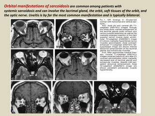 Orbital manifestations of sarcoidosis are common among patients with
systemic sarcoidosis and can involve the lacrimal gland, the orbit, soft tissues of the orbit, and
the optic nerve. Uveitis is by far the most common manifestation and is typically bilateral.
 