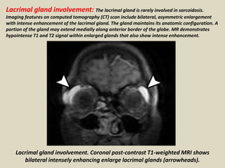 Lacrimal gland involvement: The lacrimal gland is rarely involved in sarcoidosis.
Imaging features on computed tomography (CT) scan include bilateral, asymmetric enlargement
with intense enhancement of the lacrimal gland. The gland maintains its anatomic configuration. A
portion of the gland may extend medially along anterior border of the globe. MR demonstrates
hypointense T1 and T2 signal within enlarged glands that also show intense enhancement.
Lacrimal gland involvement. Coronal post-contrast T1-weighted MRI shows
bilateral intensely enhancing enlarge lacrimal glands (arrowheads).
 