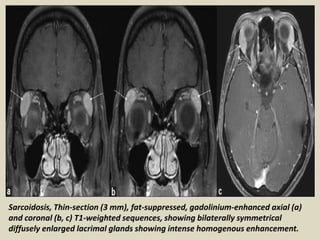 Sarcoidosis, Thin-section (3 mm), fat-suppressed, gadolinium-enhanced axial (a)
and coronal (b, c) T1-weighted sequences, showing bilaterally symmetrical
diffusely enlarged lacrimal glands showing intense homogenous enhancement.
 