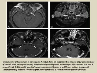 Cranial nerve enhancement in sarcoidosis. A and B, Axial fat-suppressed T1 images show enhancement
of the left optic nerve (thin arrow). Lacrimal and parotid glands are enlarged (thick arrows in A and B,
respectively). C, Bilateral trigeminal nerve enhancement is seen in a different patient (arrows). D,
Enhancement of bilateral seventh-eighth nerve complexes is seen in another patient (arrows).
 