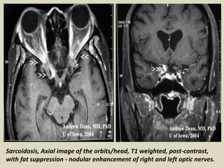 Sarcoidosis, Axial image of the orbits/head, T1 weighted, post-contrast,
with fat suppression - nodular enhancement of right and left optic nerves.
 