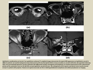 Ophthalmic manifestations of sarcoid. Four gadolinium-enhanced T1-weighted images demonstrate the typical MRI appearances of ophthalmic sarcoid in
different patients: (a) marked enlargement and enhancement of the lacrimal glands (thick arrows) secondary to sarcoid in filtration; (b) expanded enhancing
optic nerve (arrowhead) typical for sarcoid in filtration (the differential includes meningioma and lymphoma; (c) marked enhancement of the subarachnoid
portion of the oculomotor nerve on the left (thin arrows) typical for sarcoid; (d) mass- like enlargement of the superior and lateral rectus muscles (curved
arrow) in a patient with proptosis. Features are typical of sarcoid, but this is indistinguishable from lymphoma and orbital pseudotumor on imaging.
 