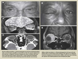 Discrete orbital sarcoidosis. A, Clinical photograph of an 83-year-old female patient
with a 2-month history of puffiness around left eye. Note the superior displacement
of the left eye. B, Magnetic resonance imaging scan shows a localized soft tissue
mass in the left anterior inferior orbit (arrow). C, Axial computed tomographic
scan of the same patient shows thickening around the left optic nerve (arrow).
Diffuse orbital sarcoidosis. A, Clinical photograph of a 63-year-old male
patient with a 5-week history of lid swelling in the right eye. B, Magnetic
resonance imaging scan demonstrates a diffuse soft tissue mass involving
the superior and medial quadrants and enveloping the globe.
 