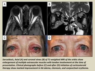 Sarcoidosis, Axial (A) and coronal views (B) of T1-weighted MRI of the orbits show
enlargement of multiple extraocular muscles with tendon involvement at the time of
presentation. Clinical photographs before (C) and after (D) initiation of corticosteroid
therapy show marked improvement in lid edema, chemosis, and conjunctival erythema.
 