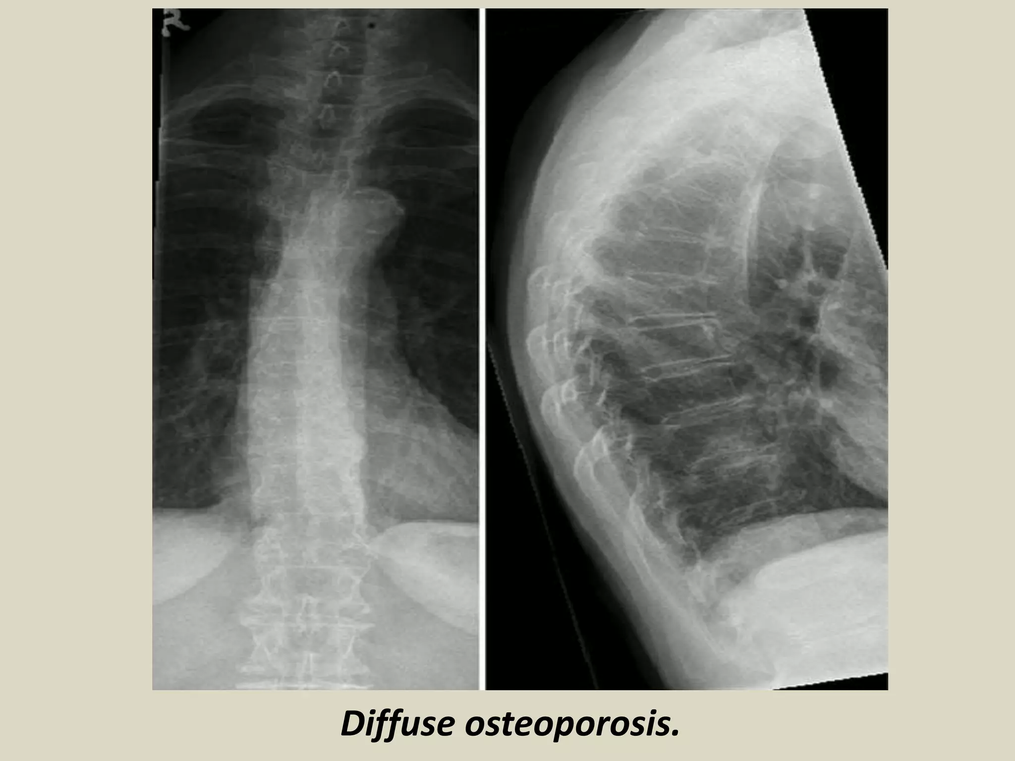 Presentation1.pptx, radiological imaging of metabolic bone diseases. | PPTX