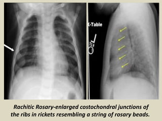 Presentation1.pptx, radiological imaging of metabolic bone diseases. | PPTX