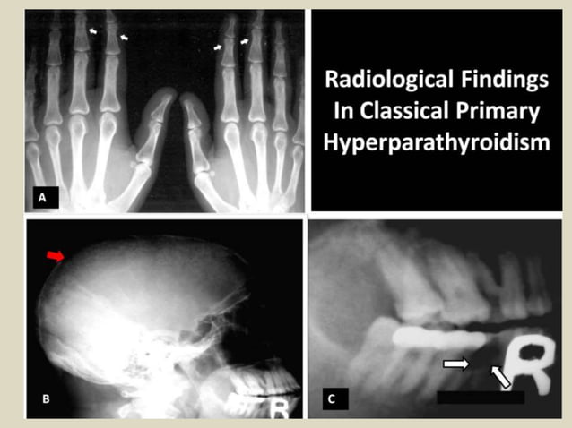 Presentation1.pptx, radiological imaging of metabolic bone diseases ...