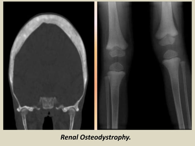 Presentation1.pptx, radiological imaging of metabolic bone diseases ...