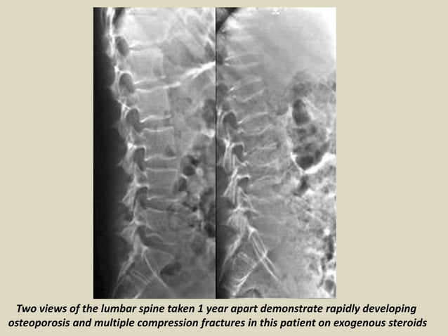 Presentation1.pptx, radiological imaging of metabolic bone diseases ...