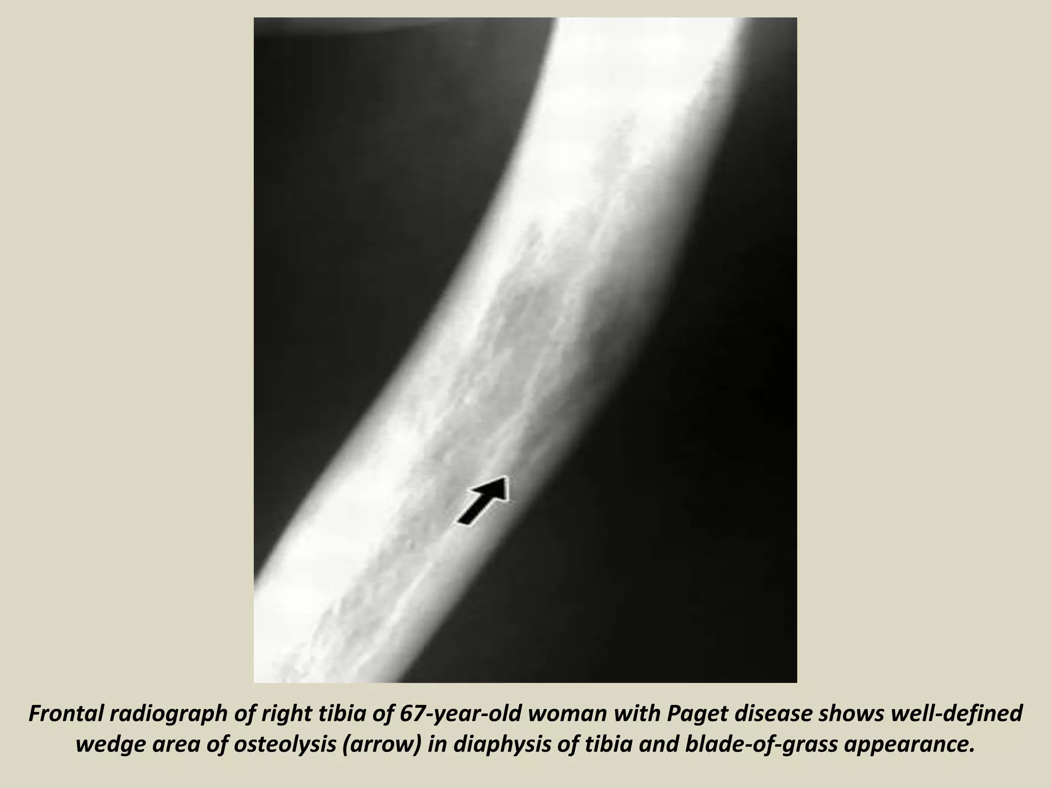 Frontal radiograph of right tibia of 67-year-old woman with Paget disease shows well-defined
wedge area of osteolysis (arrow) in diaphysis of tibia and blade-of-grass appearance.
 