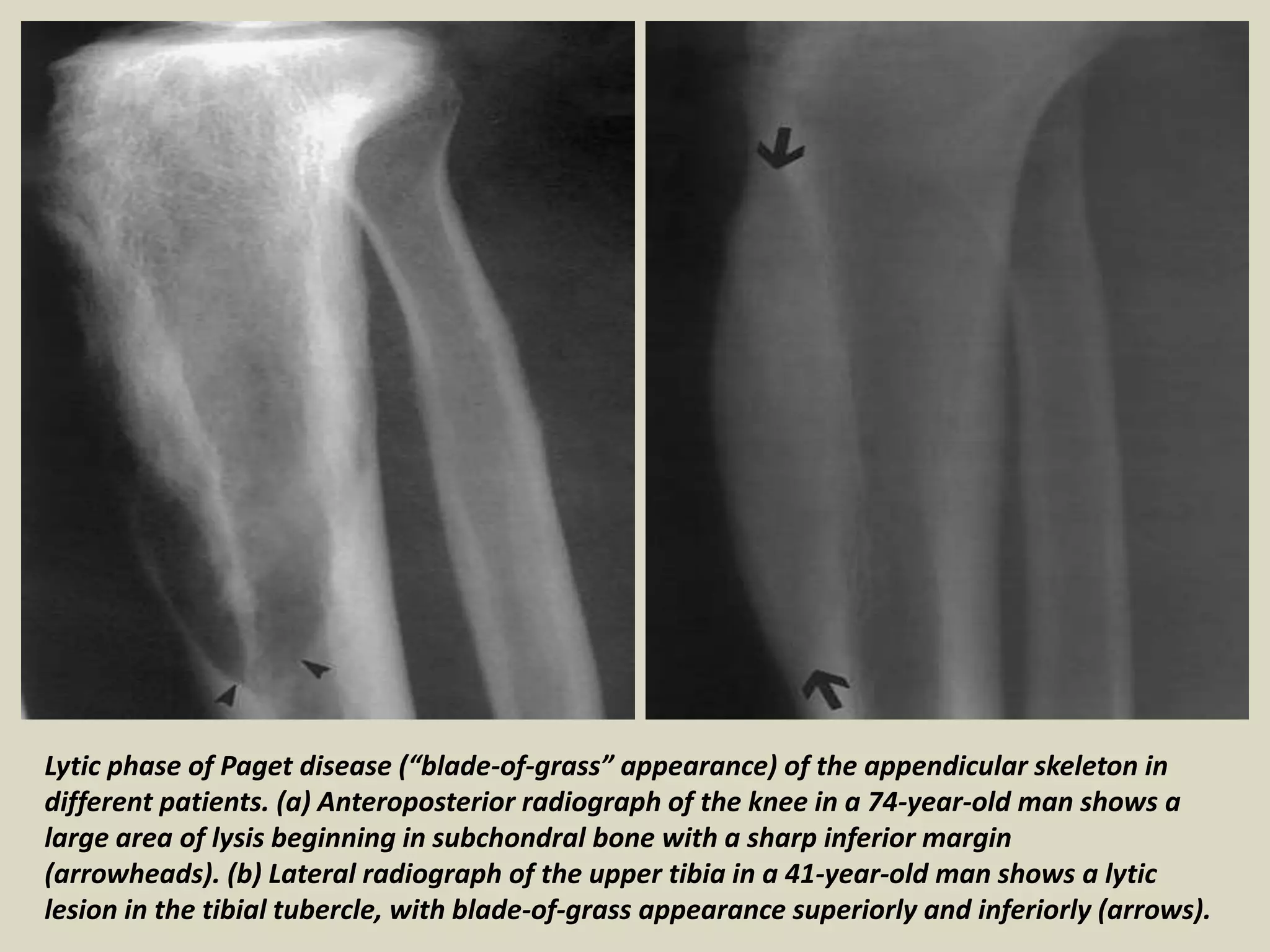 Lytic phase of Paget disease (“blade-of-grass” appearance) of the appendicular skeleton in
different patients. (a) Anteroposterior radiograph of the knee in a 74-year-old man shows a
large area of lysis beginning in subchondral bone with a sharp inferior margin
(arrowheads). (b) Lateral radiograph of the upper tibia in a 41-year-old man shows a lytic
lesion in the tibial tubercle, with blade-of-grass appearance superiorly and inferiorly (arrows).
 