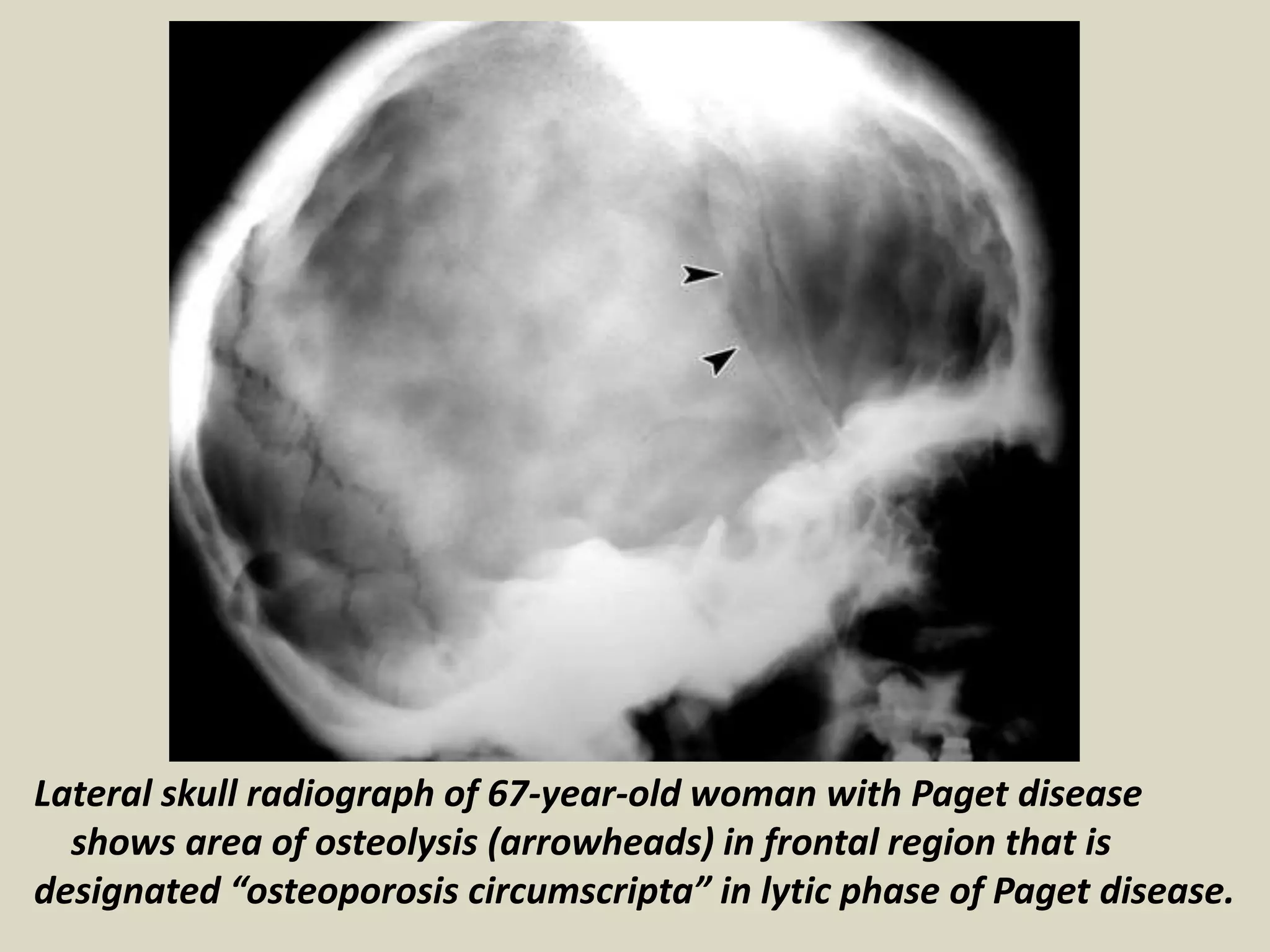 Lateral skull radiograph of 67-year-old woman with Paget disease
shows area of osteolysis (arrowheads) in frontal region that is
designated “osteoporosis circumscripta” in lytic phase of Paget disease.
 