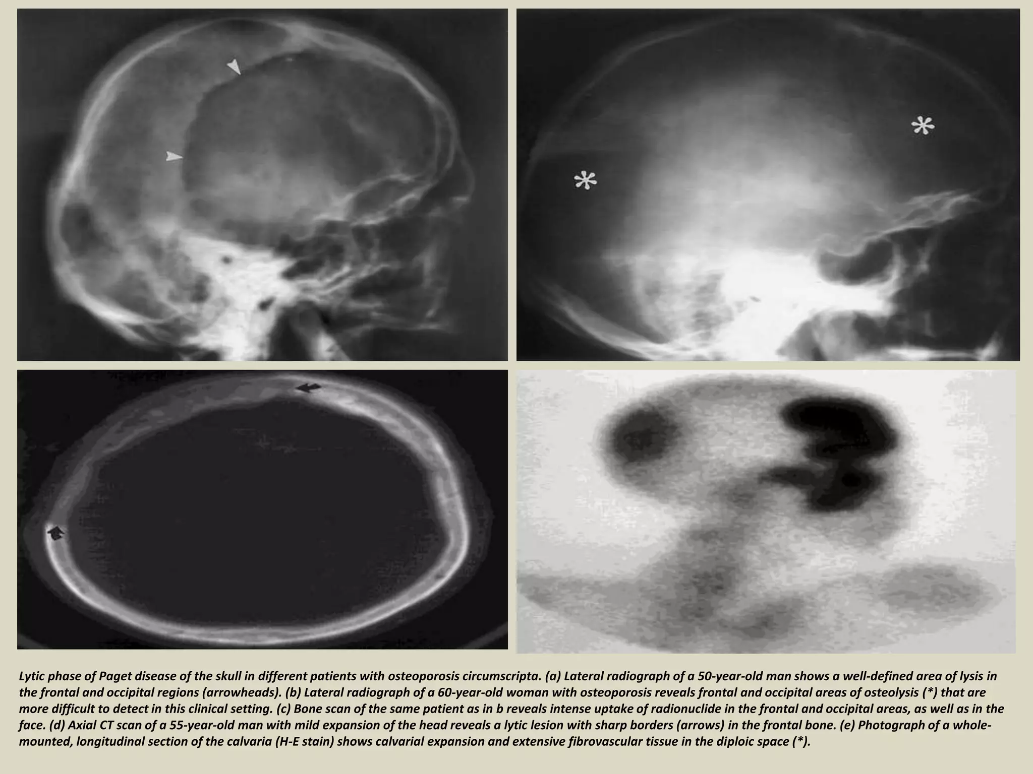 Lytic phase of Paget disease of the skull in different patients with osteoporosis circumscripta. (a) Lateral radiograph of a 50-year-old man shows a well-defined area of lysis in
the frontal and occipital regions (arrowheads). (b) Lateral radiograph of a 60-year-old woman with osteoporosis reveals frontal and occipital areas of osteolysis (*) that are
more difficult to detect in this clinical setting. (c) Bone scan of the same patient as in b reveals intense uptake of radionuclide in the frontal and occipital areas, as well as in the
face. (d) Axial CT scan of a 55-year-old man with mild expansion of the head reveals a lytic lesion with sharp borders (arrows) in the frontal bone. (e) Photograph of a whole-
mounted, longitudinal section of the calvaria (H-E stain) shows calvarial expansion and extensive fibrovascular tissue in the diploic space (*).
 