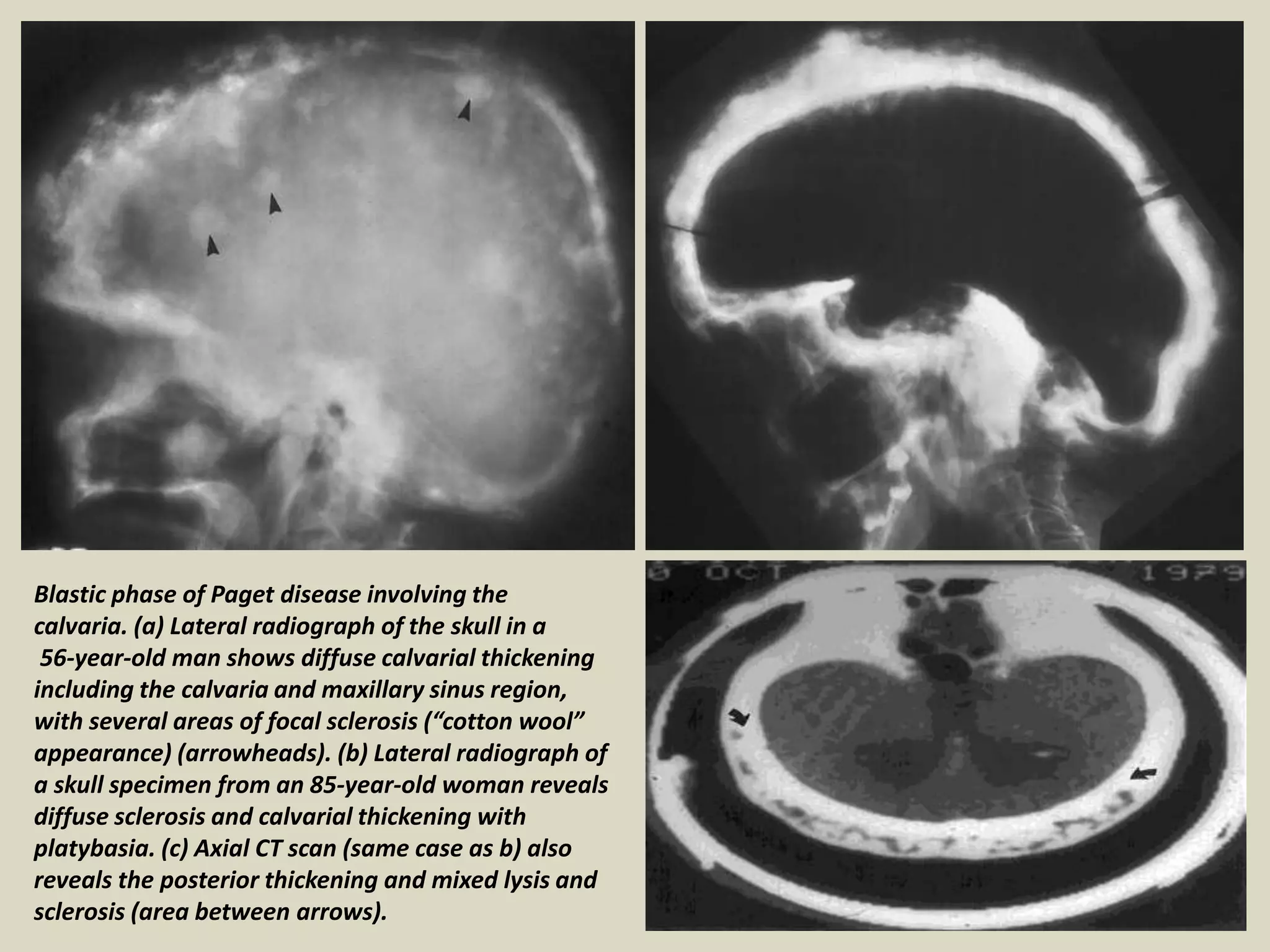 Blastic phase of Paget disease involving the
calvaria. (a) Lateral radiograph of the skull in a
56-year-old man shows diffuse calvarial thickening
including the calvaria and maxillary sinus region,
with several areas of focal sclerosis (“cotton wool”
appearance) (arrowheads). (b) Lateral radiograph of
a skull specimen from an 85-year-old woman reveals
diffuse sclerosis and calvarial thickening with
platybasia. (c) Axial CT scan (same case as b) also
reveals the posterior thickening and mixed lysis and
sclerosis (area between arrows).
 