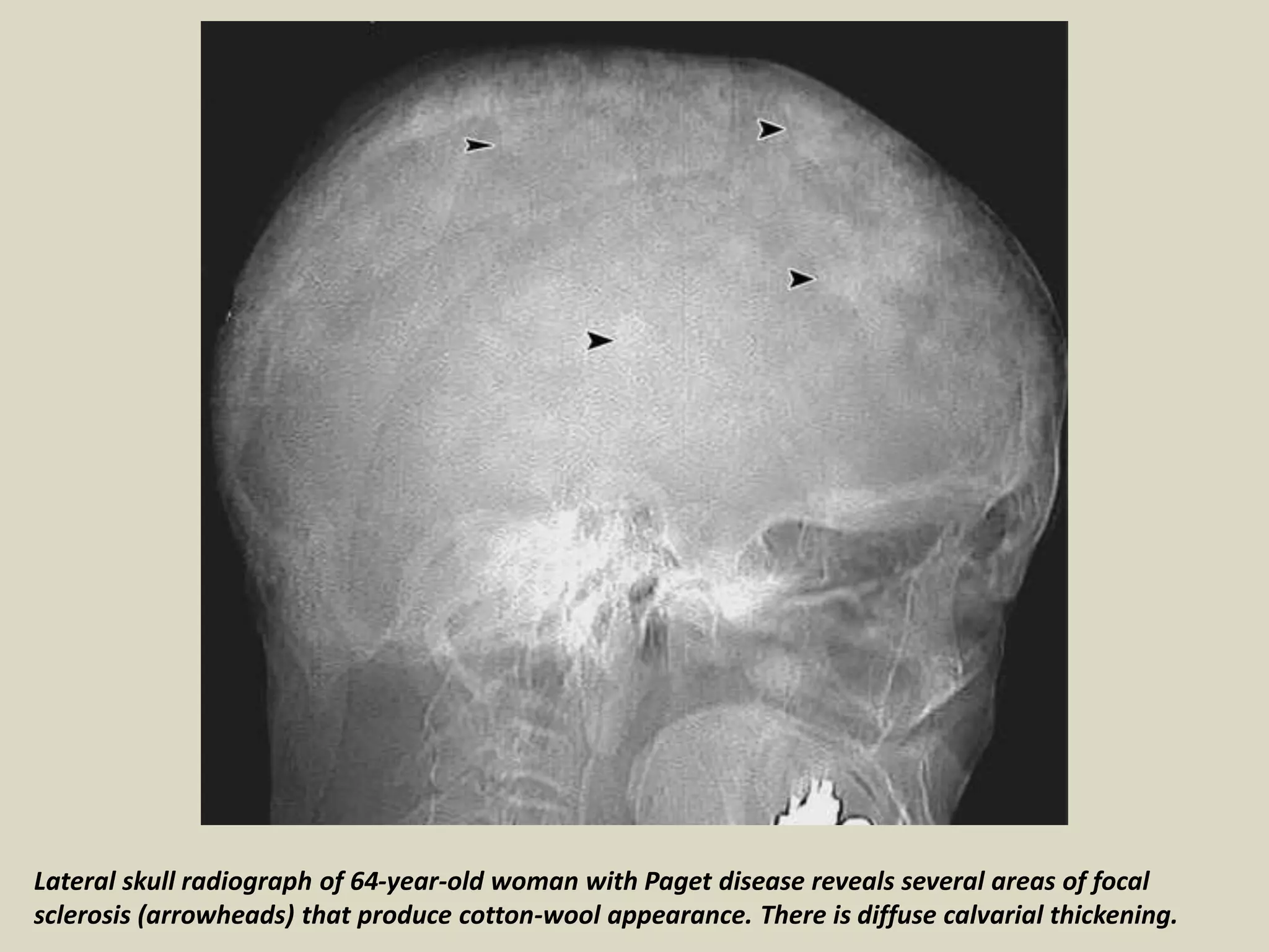 Lateral skull radiograph of 64-year-old woman with Paget disease reveals several areas of focal
sclerosis (arrowheads) that produce cotton-wool appearance. There is diffuse calvarial thickening.
 