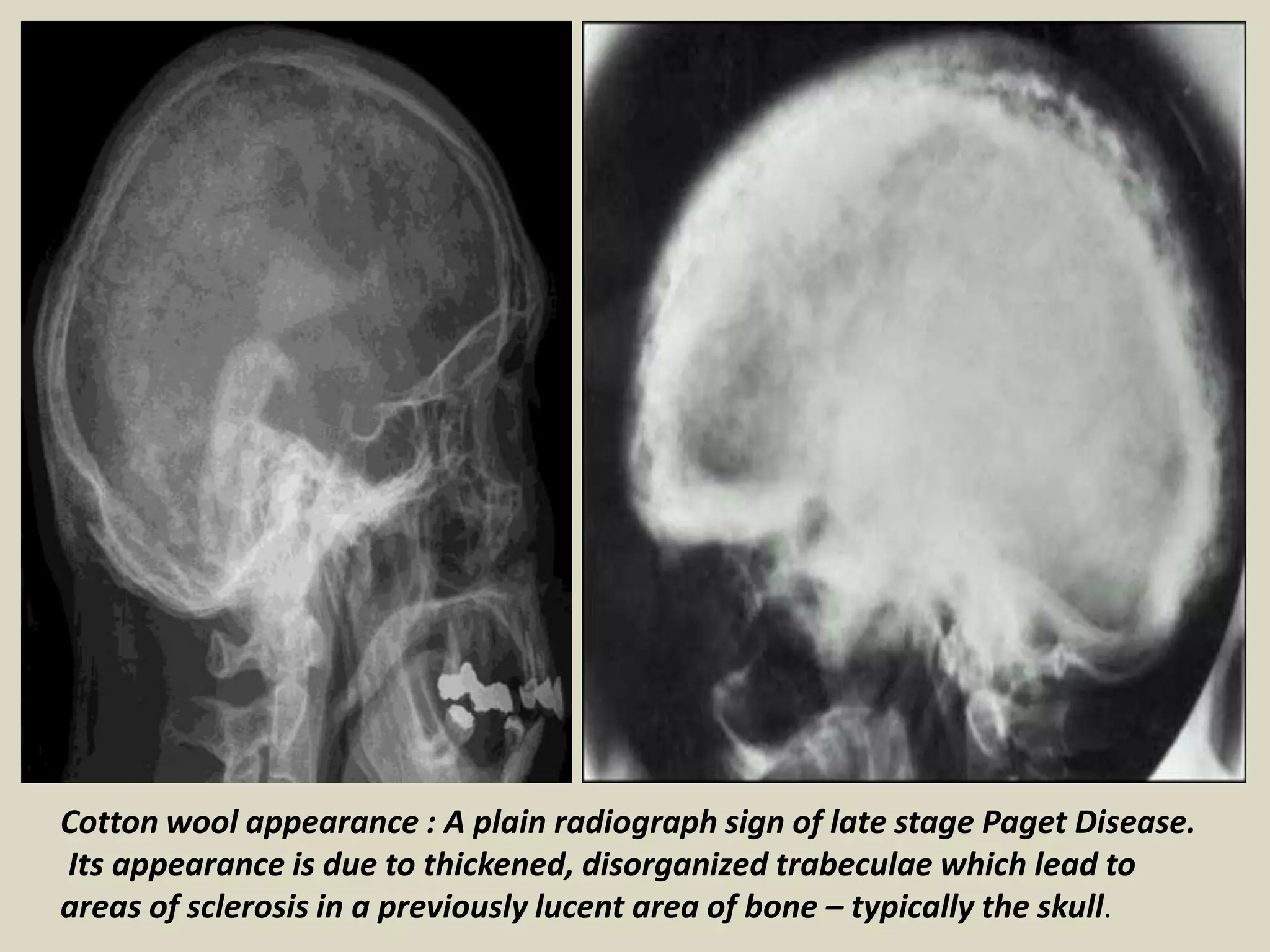 Cotton wool appearance : A plain radiograph sign of late stage Paget Disease.
Its appearance is due to thickened, disorganized trabeculae which lead to
areas of sclerosis in a previously lucent area of bone – typically the skull.
 
