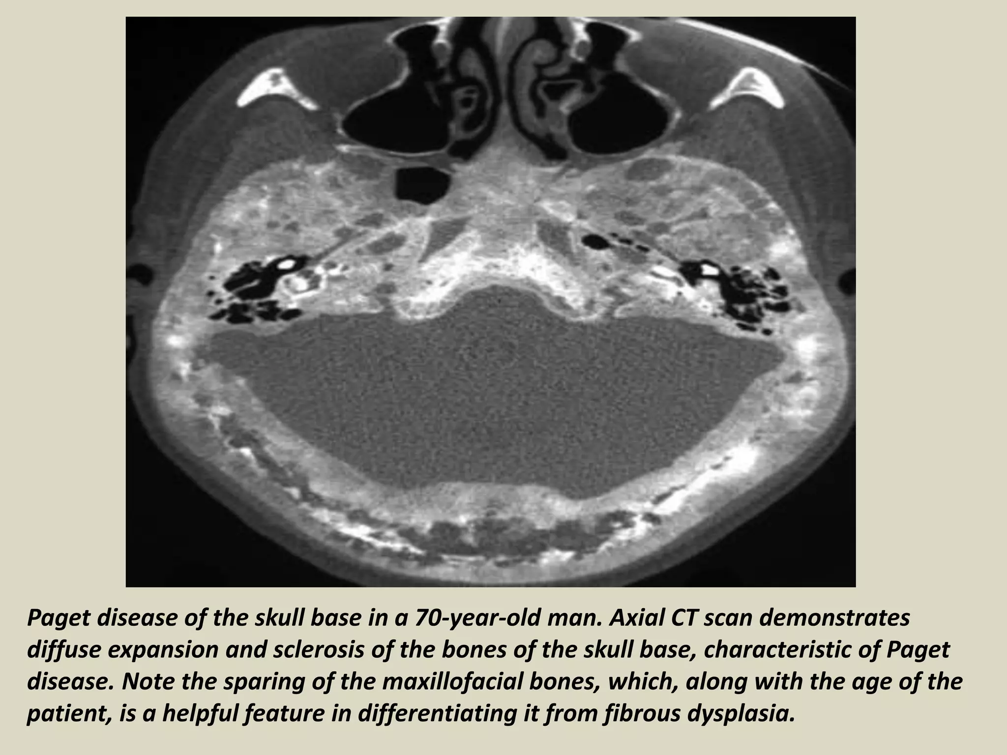 Paget disease of the skull base in a 70-year-old man. Axial CT scan demonstrates
diffuse expansion and sclerosis of the bones of the skull base, characteristic of Paget
disease. Note the sparing of the maxillofacial bones, which, along with the age of the
patient, is a helpful feature in differentiating it from fibrous dysplasia.
 