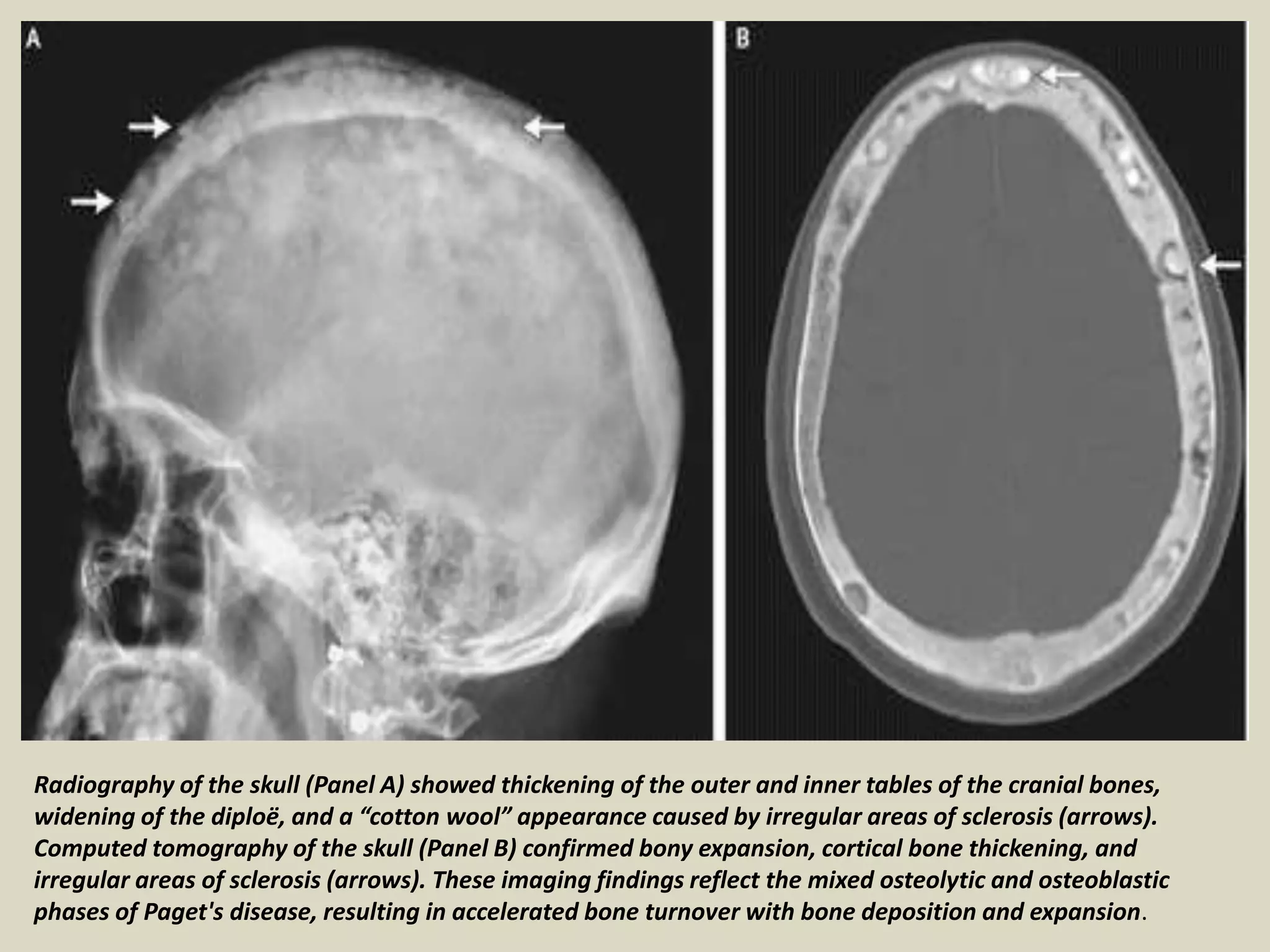 Radiography of the skull (Panel A) showed thickening of the outer and inner tables of the cranial bones,
widening of the diploë, and a “cotton wool” appearance caused by irregular areas of sclerosis (arrows).
Computed tomography of the skull (Panel B) confirmed bony expansion, cortical bone thickening, and
irregular areas of sclerosis (arrows). These imaging findings reflect the mixed osteolytic and osteoblastic
phases of Paget's disease, resulting in accelerated bone turnover with bone deposition and expansion.
 