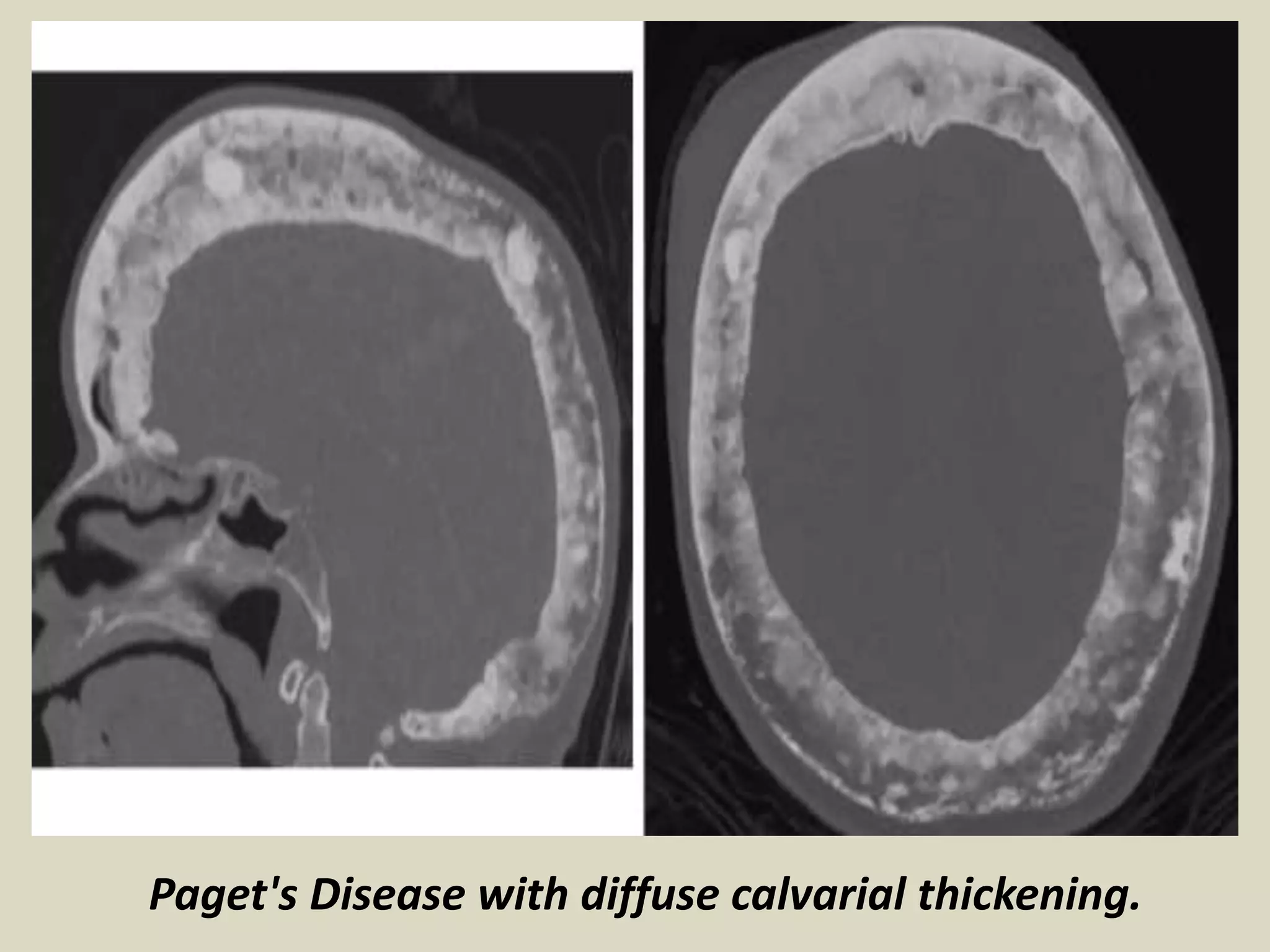 Paget's Disease with diffuse calvarial thickening.
 