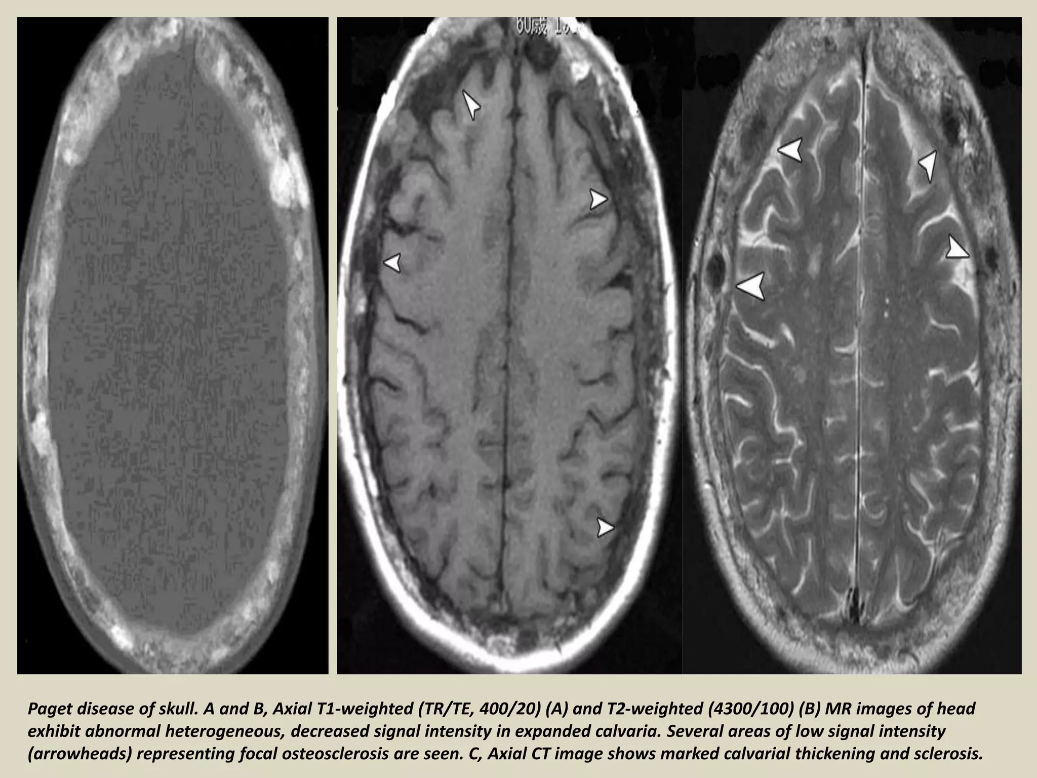 Paget disease of skull. A and B, Axial T1-weighted (TR/TE, 400/20) (A) and T2-weighted (4300/100) (B) MR images of head
exhibit abnormal heterogeneous, decreased signal intensity in expanded calvaria. Several areas of low signal intensity
(arrowheads) representing focal osteosclerosis are seen. C, Axial CT image shows marked calvarial thickening and sclerosis.
 