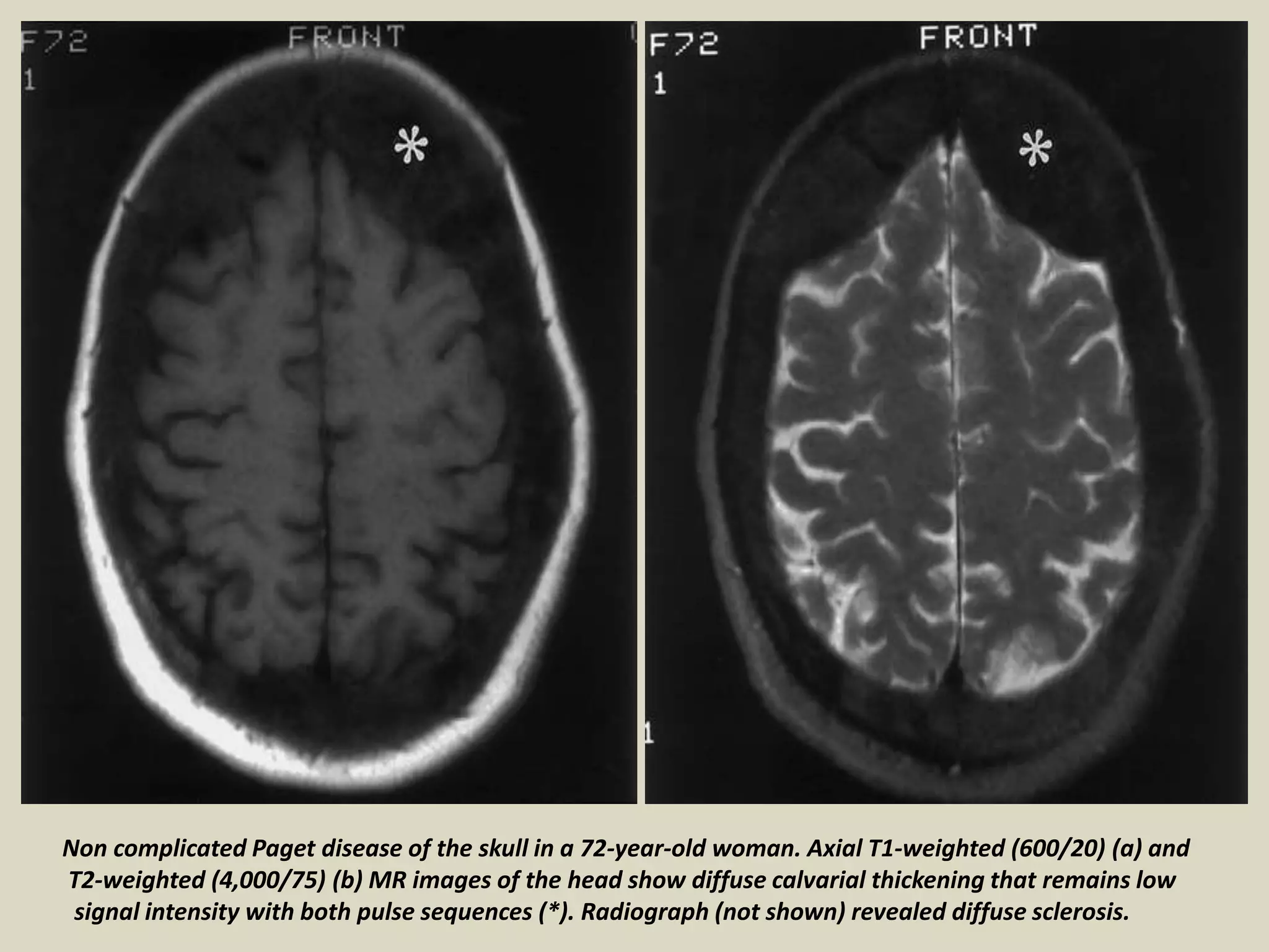 Non complicated Paget disease of the skull in a 72-year-old woman. Axial T1-weighted (600/20) (a) and
T2-weighted (4,000/75) (b) MR images of the head show diffuse calvarial thickening that remains low
signal intensity with both pulse sequences (*). Radiograph (not shown) revealed diffuse sclerosis.
 