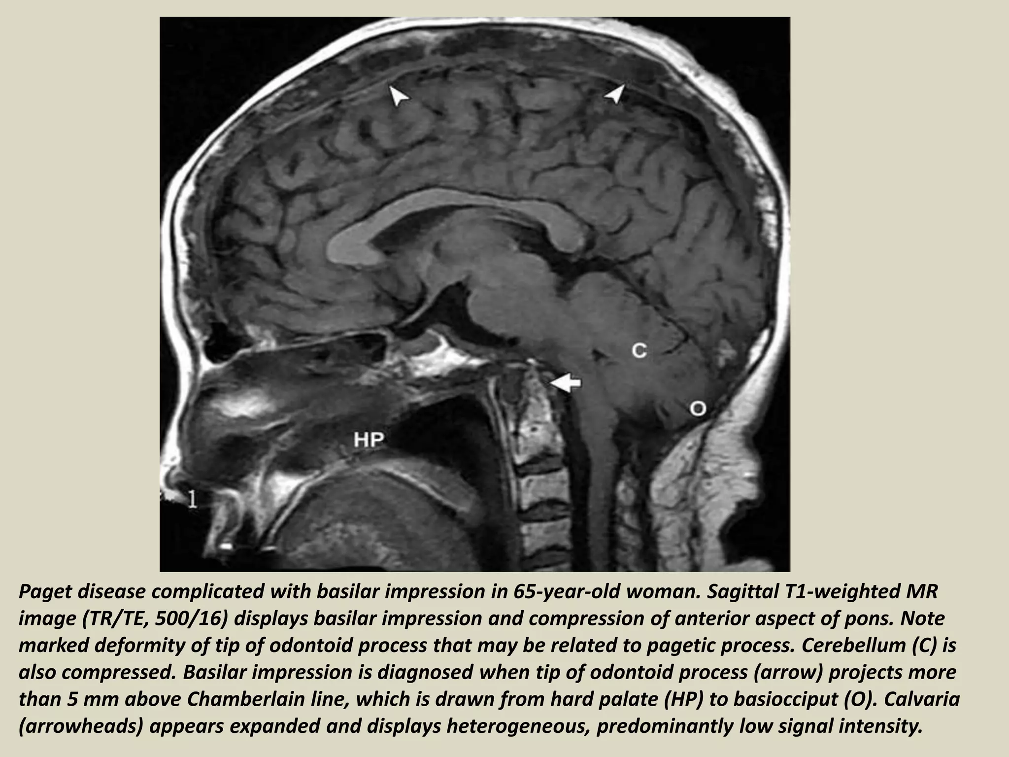 Paget disease complicated with basilar impression in 65-year-old woman. Sagittal T1-weighted MR
image (TR/TE, 500/16) displays basilar impression and compression of anterior aspect of pons. Note
marked deformity of tip of odontoid process that may be related to pagetic process. Cerebellum (C) is
also compressed. Basilar impression is diagnosed when tip of odontoid process (arrow) projects more
than 5 mm above Chamberlain line, which is drawn from hard palate (HP) to basiocciput (O). Calvaria
(arrowheads) appears expanded and displays heterogeneous, predominantly low signal intensity.
 
