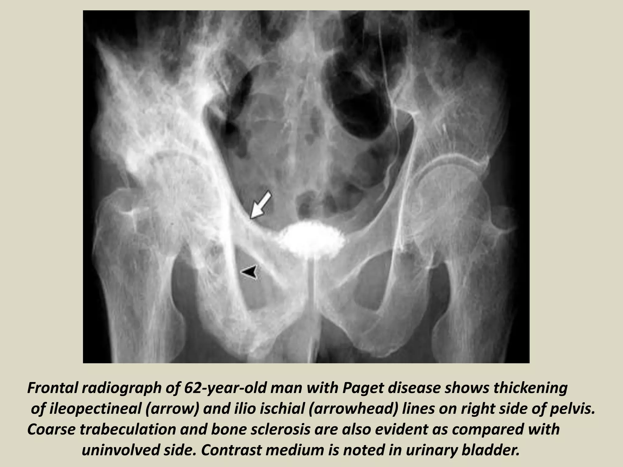 Frontal radiograph of 62-year-old man with Paget disease shows thickening
of ileopectineal (arrow) and ilio ischial (arrowhead) lines on right side of pelvis.
Coarse trabeculation and bone sclerosis are also evident as compared with
uninvolved side. Contrast medium is noted in urinary bladder.
 