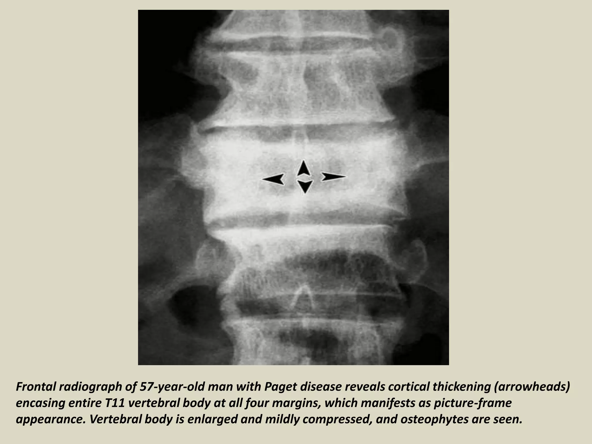 Frontal radiograph of 57-year-old man with Paget disease reveals cortical thickening (arrowheads)
encasing entire T11 vertebral body at all four margins, which manifests as picture-frame
appearance. Vertebral body is enlarged and mildly compressed, and osteophytes are seen.
 
