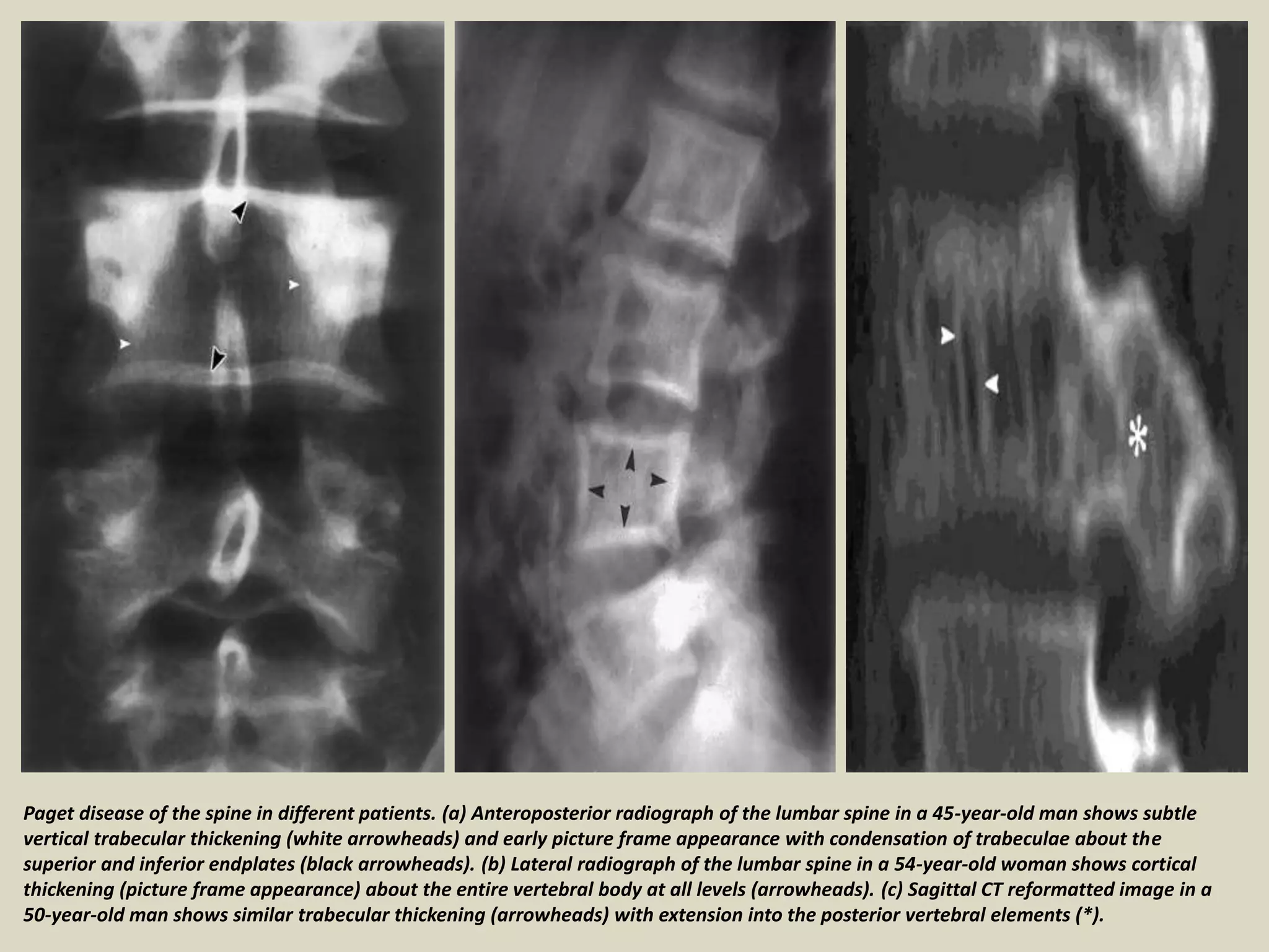 Paget disease of the spine in different patients. (a) Anteroposterior radiograph of the lumbar spine in a 45-year-old man shows subtle
vertical trabecular thickening (white arrowheads) and early picture frame appearance with condensation of trabeculae about the
superior and inferior endplates (black arrowheads). (b) Lateral radiograph of the lumbar spine in a 54-year-old woman shows cortical
thickening (picture frame appearance) about the entire vertebral body at all levels (arrowheads). (c) Sagittal CT reformatted image in a
50-year-old man shows similar trabecular thickening (arrowheads) with extension into the posterior vertebral elements (*).
 