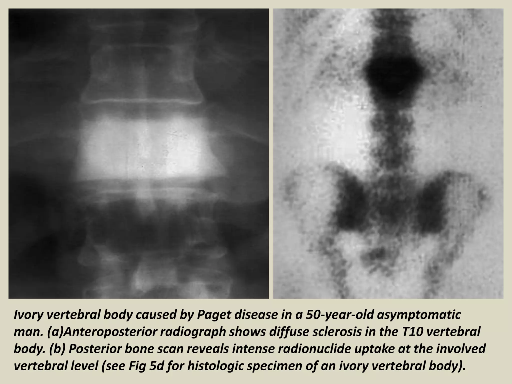 Ivory vertebral body caused by Paget disease in a 50-year-old asymptomatic
man. (a)Anteroposterior radiograph shows diffuse sclerosis in the T10 vertebral
body. (b) Posterior bone scan reveals intense radionuclide uptake at the involved
vertebral level (see Fig 5d for histologic specimen of an ivory vertebral body).
 