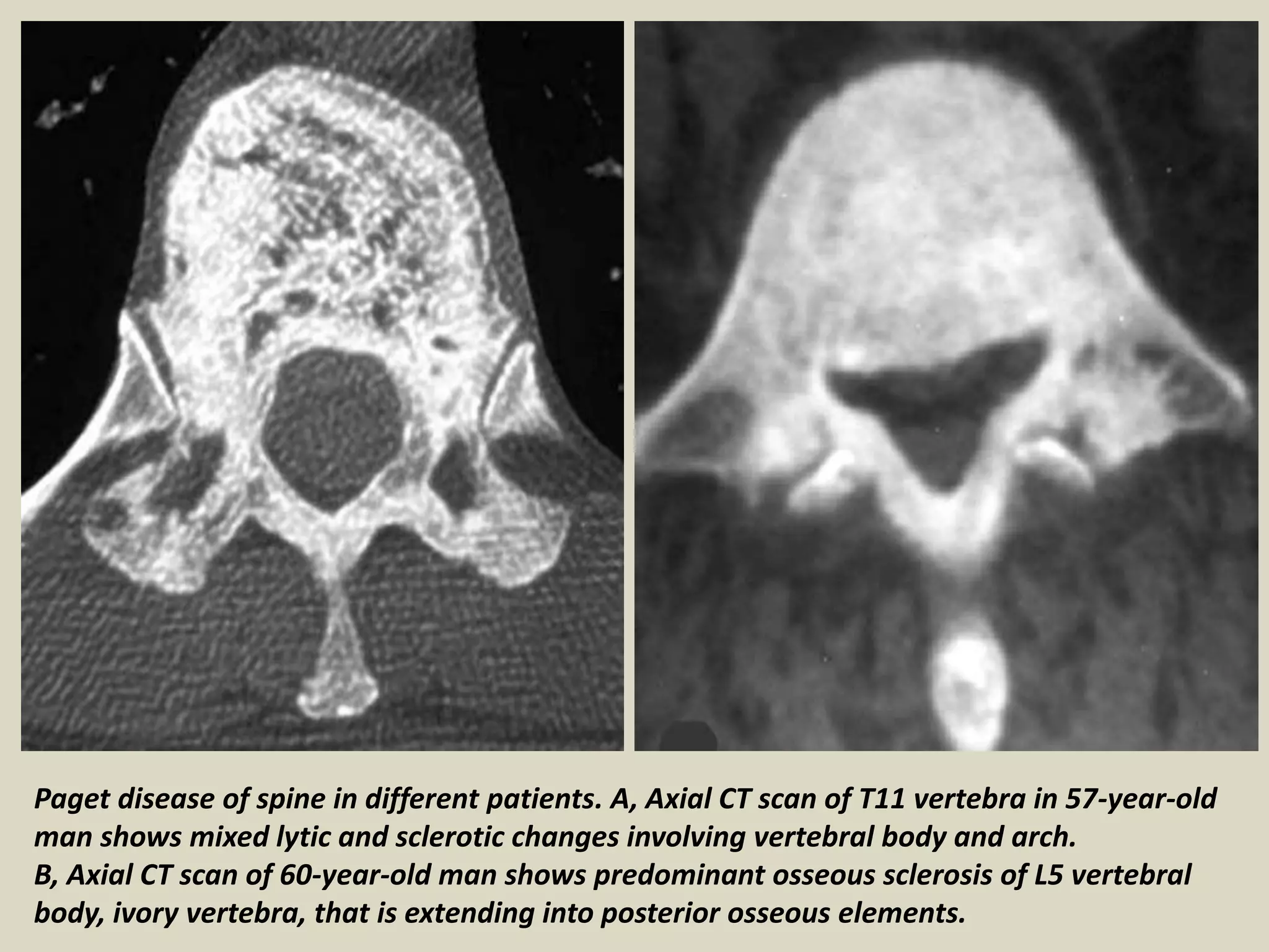 Paget disease of spine in different patients. A, Axial CT scan of T11 vertebra in 57-year-old
man shows mixed lytic and sclerotic changes involving vertebral body and arch.
B, Axial CT scan of 60-year-old man shows predominant osseous sclerosis of L5 vertebral
body, ivory vertebra, that is extending into posterior osseous elements.
 