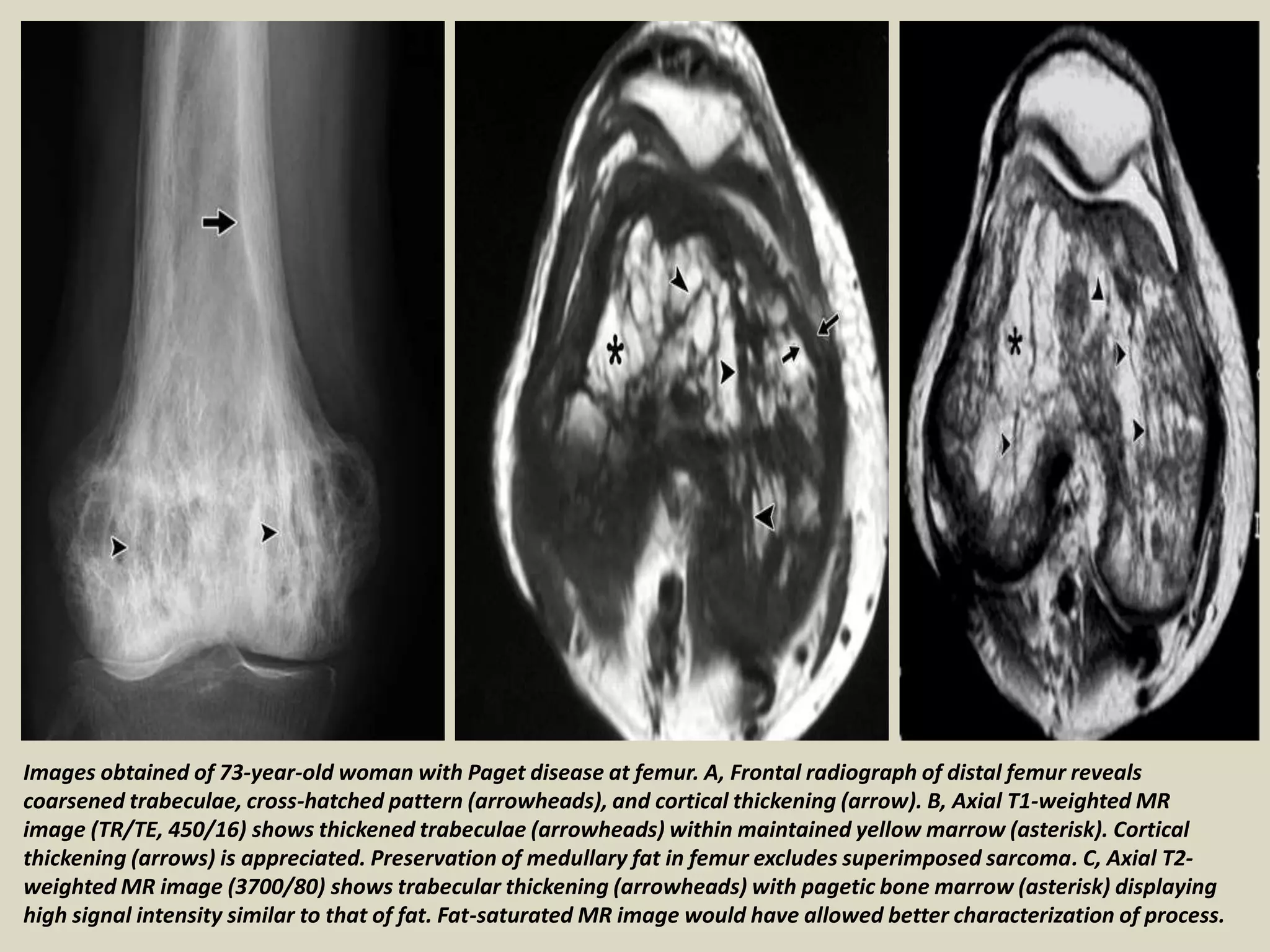 Images obtained of 73-year-old woman with Paget disease at femur. A, Frontal radiograph of distal femur reveals
coarsened trabeculae, cross-hatched pattern (arrowheads), and cortical thickening (arrow). B, Axial T1-weighted MR
image (TR/TE, 450/16) shows thickened trabeculae (arrowheads) within maintained yellow marrow (asterisk). Cortical
thickening (arrows) is appreciated. Preservation of medullary fat in femur excludes superimposed sarcoma. C, Axial T2-
weighted MR image (3700/80) shows trabecular thickening (arrowheads) with pagetic bone marrow (asterisk) displaying
high signal intensity similar to that of fat. Fat-saturated MR image would have allowed better characterization of process.
 