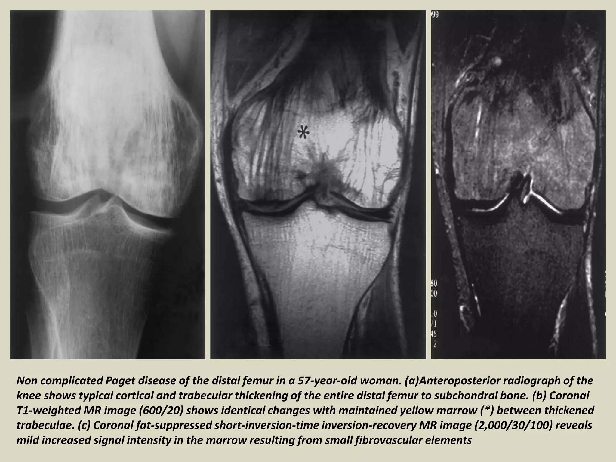 Non complicated Paget disease of the distal femur in a 57-year-old woman. (a)Anteroposterior radiograph of the
knee shows typical cortical and trabecular thickening of the entire distal femur to subchondral bone. (b) Coronal
T1-weighted MR image (600/20) shows identical changes with maintained yellow marrow (*) between thickened
trabeculae. (c) Coronal fat-suppressed short-inversion-time inversion-recovery MR image (2,000/30/100) reveals
mild increased signal intensity in the marrow resulting from small fibrovascular elements
 