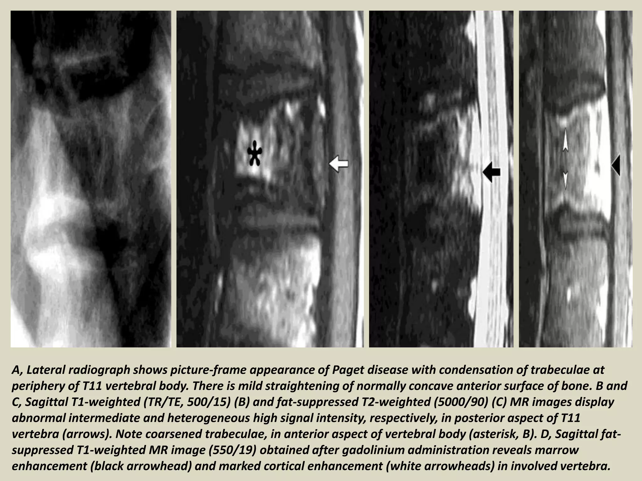 A, Lateral radiograph shows picture-frame appearance of Paget disease with condensation of trabeculae at
periphery of T11 vertebral body. There is mild straightening of normally concave anterior surface of bone. B and
C, Sagittal T1-weighted (TR/TE, 500/15) (B) and fat-suppressed T2-weighted (5000/90) (C) MR images display
abnormal intermediate and heterogeneous high signal intensity, respectively, in posterior aspect of T11
vertebra (arrows). Note coarsened trabeculae, in anterior aspect of vertebral body (asterisk, B). D, Sagittal fat-
suppressed T1-weighted MR image (550/19) obtained after gadolinium administration reveals marrow
enhancement (black arrowhead) and marked cortical enhancement (white arrowheads) in involved vertebra.
 