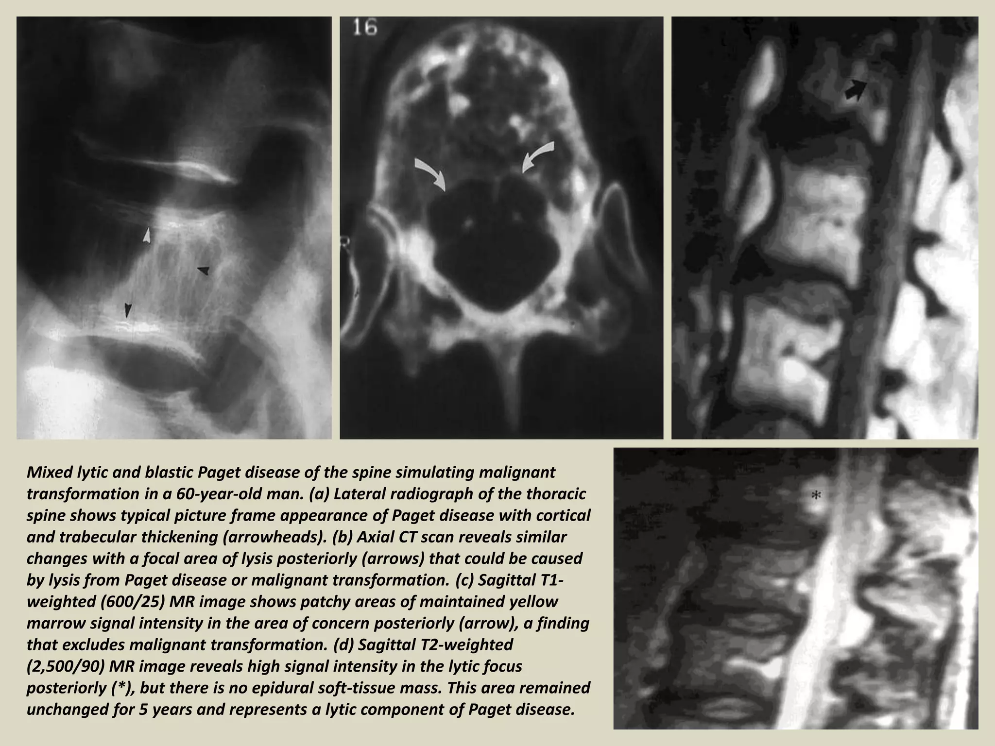 Mixed lytic and blastic Paget disease of the spine simulating malignant
transformation in a 60-year-old man. (a) Lateral radiograph of the thoracic
spine shows typical picture frame appearance of Paget disease with cortical
and trabecular thickening (arrowheads). (b) Axial CT scan reveals similar
changes with a focal area of lysis posteriorly (arrows) that could be caused
by lysis from Paget disease or malignant transformation. (c) Sagittal T1-
weighted (600/25) MR image shows patchy areas of maintained yellow
marrow signal intensity in the area of concern posteriorly (arrow), a finding
that excludes malignant transformation. (d) Sagittal T2-weighted
(2,500/90) MR image reveals high signal intensity in the lytic focus
posteriorly (*), but there is no epidural soft-tissue mass. This area remained
unchanged for 5 years and represents a lytic component of Paget disease.
 