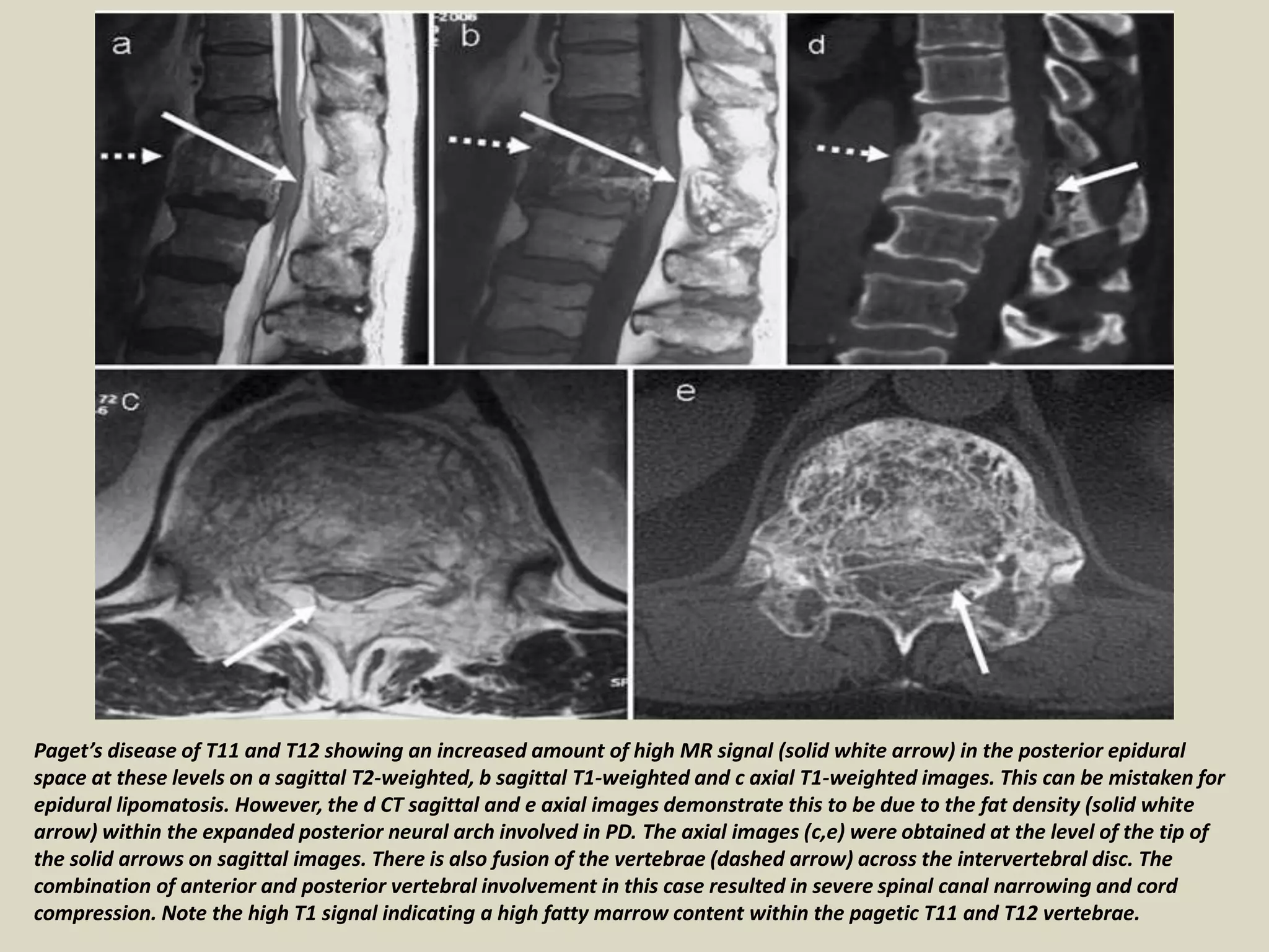 Paget’s disease of T11 and T12 showing an increased amount of high MR signal (solid white arrow) in the posterior epidural
space at these levels on a sagittal T2-weighted, b sagittal T1-weighted and c axial T1-weighted images. This can be mistaken for
epidural lipomatosis. However, the d CT sagittal and e axial images demonstrate this to be due to the fat density (solid white
arrow) within the expanded posterior neural arch involved in PD. The axial images (c,e) were obtained at the level of the tip of
the solid arrows on sagittal images. There is also fusion of the vertebrae (dashed arrow) across the intervertebral disc. The
combination of anterior and posterior vertebral involvement in this case resulted in severe spinal canal narrowing and cord
compression. Note the high T1 signal indicating a high fatty marrow content within the pagetic T11 and T12 vertebrae.
 