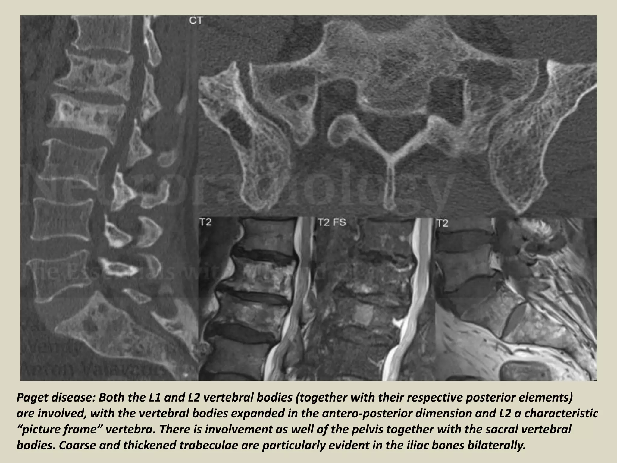 Paget disease: Both the L1 and L2 vertebral bodies (together with their respective posterior elements)
are involved, with the vertebral bodies expanded in the antero-posterior dimension and L2 a characteristic
“picture frame” vertebra. There is involvement as well of the pelvis together with the sacral vertebral
bodies. Coarse and thickened trabeculae are particularly evident in the iliac bones bilaterally.
 