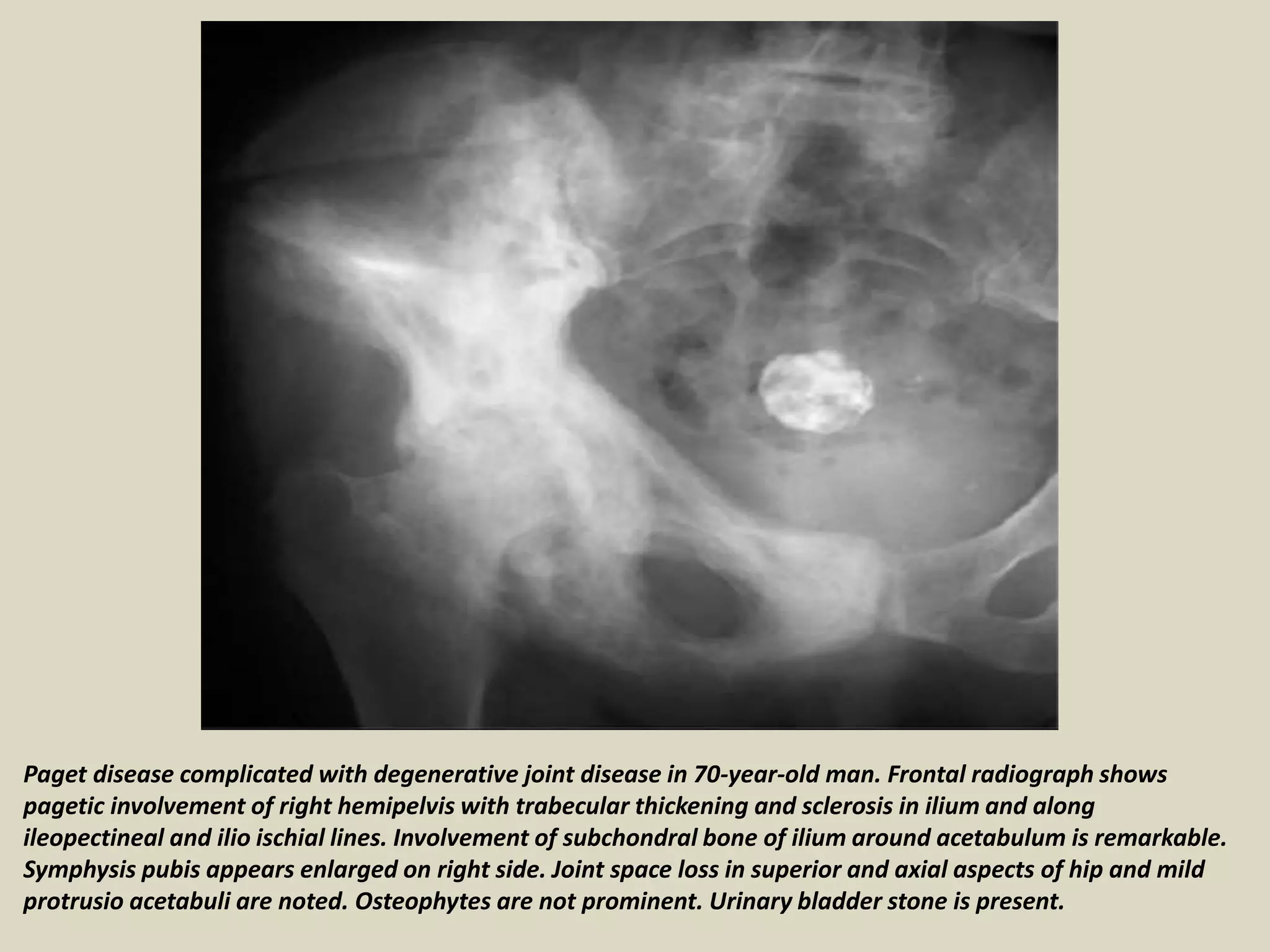 Paget disease complicated with degenerative joint disease in 70-year-old man. Frontal radiograph shows
pagetic involvement of right hemipelvis with trabecular thickening and sclerosis in ilium and along
ileopectineal and ilio ischial lines. Involvement of subchondral bone of ilium around acetabulum is remarkable.
Symphysis pubis appears enlarged on right side. Joint space loss in superior and axial aspects of hip and mild
protrusio acetabuli are noted. Osteophytes are not prominent. Urinary bladder stone is present.
 