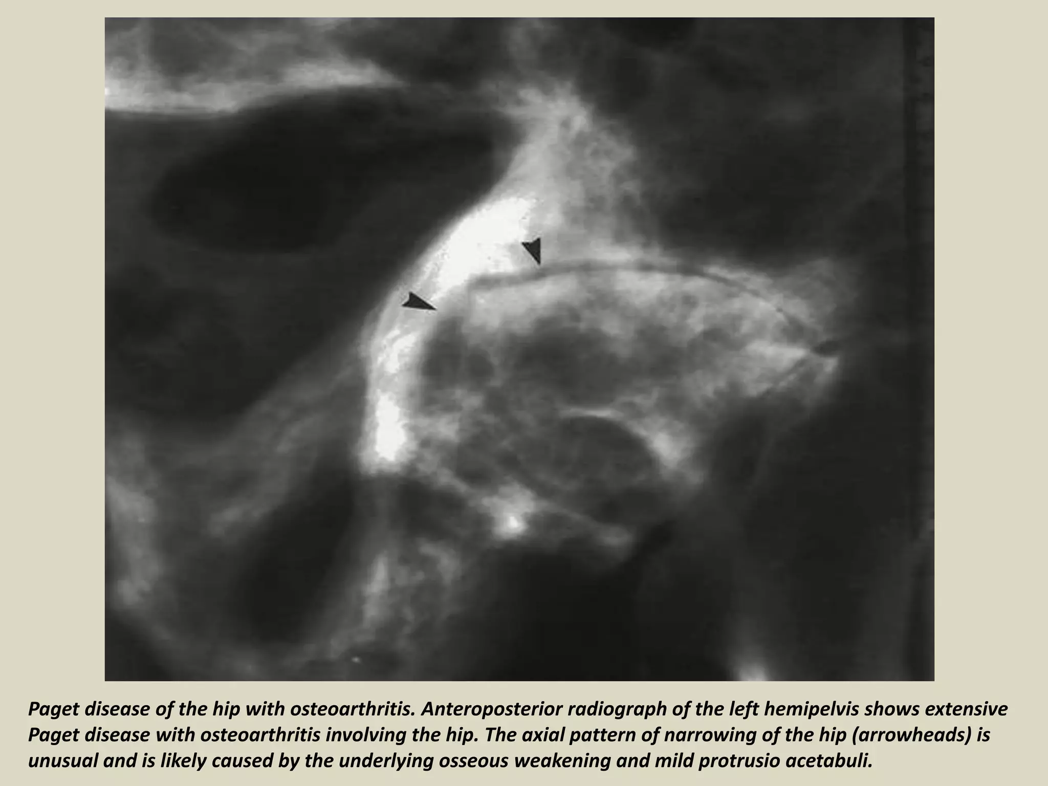 Paget disease of the hip with osteoarthritis. Anteroposterior radiograph of the left hemipelvis shows extensive
Paget disease with osteoarthritis involving the hip. The axial pattern of narrowing of the hip (arrowheads) is
unusual and is likely caused by the underlying osseous weakening and mild protrusio acetabuli.
 