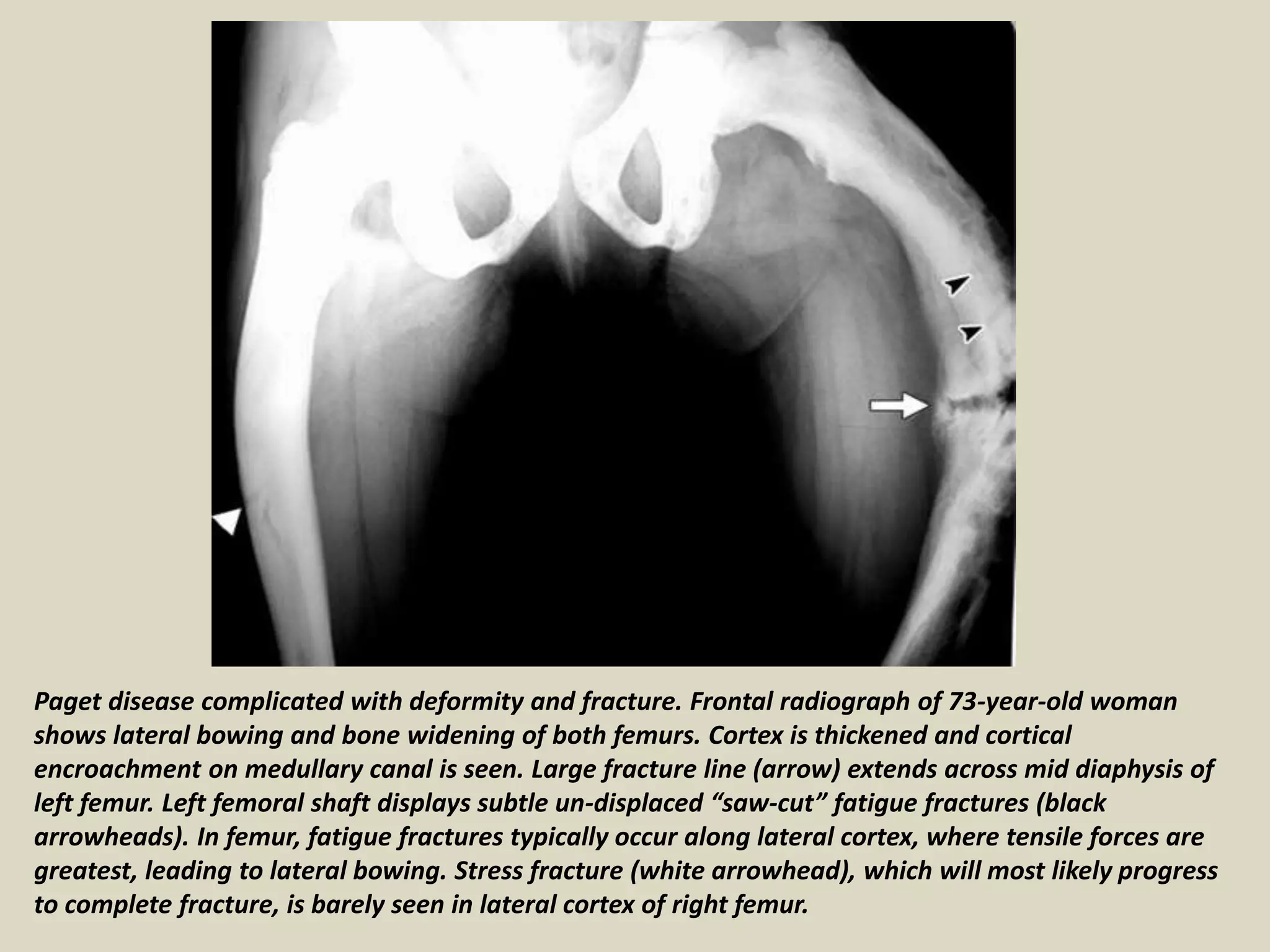 Paget disease complicated with deformity and fracture. Frontal radiograph of 73-year-old woman
shows lateral bowing and bone widening of both femurs. Cortex is thickened and cortical
encroachment on medullary canal is seen. Large fracture line (arrow) extends across mid diaphysis of
left femur. Left femoral shaft displays subtle un-displaced “saw-cut” fatigue fractures (black
arrowheads). In femur, fatigue fractures typically occur along lateral cortex, where tensile forces are
greatest, leading to lateral bowing. Stress fracture (white arrowhead), which will most likely progress
to complete fracture, is barely seen in lateral cortex of right femur.
 