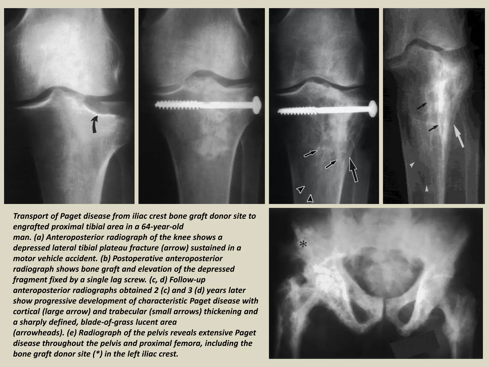Transport of Paget disease from iliac crest bone graft donor site to
engrafted proximal tibial area in a 64-year-old
man. (a) Anteroposterior radiograph of the knee shows a
depressed lateral tibial plateau fracture (arrow) sustained in a
motor vehicle accident. (b) Postoperative anteroposterior
radiograph shows bone graft and elevation of the depressed
fragment fixed by a single lag screw. (c, d) Follow-up
anteroposterior radiographs obtained 2 (c) and 3 (d) years later
show progressive development of characteristic Paget disease with
cortical (large arrow) and trabecular (small arrows) thickening and
a sharply defined, blade-of-grass lucent area
(arrowheads). (e) Radiograph of the pelvis reveals extensive Paget
disease throughout the pelvis and proximal femora, including the
bone graft donor site (*) in the left iliac crest.
 