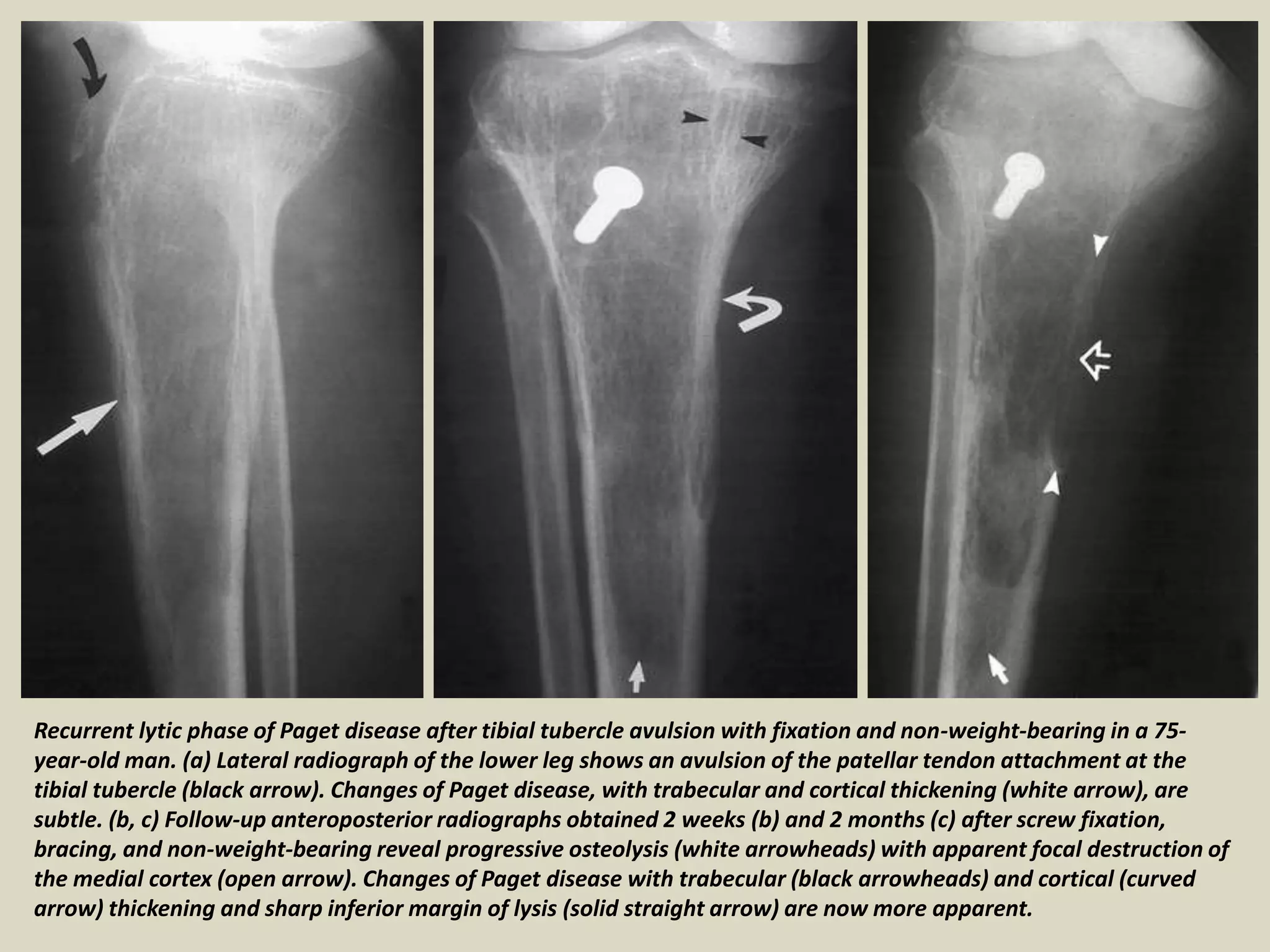 Recurrent lytic phase of Paget disease after tibial tubercle avulsion with fixation and non-weight-bearing in a 75-
year-old man. (a) Lateral radiograph of the lower leg shows an avulsion of the patellar tendon attachment at the
tibial tubercle (black arrow). Changes of Paget disease, with trabecular and cortical thickening (white arrow), are
subtle. (b, c) Follow-up anteroposterior radiographs obtained 2 weeks (b) and 2 months (c) after screw fixation,
bracing, and non-weight-bearing reveal progressive osteolysis (white arrowheads) with apparent focal destruction of
the medial cortex (open arrow). Changes of Paget disease with trabecular (black arrowheads) and cortical (curved
arrow) thickening and sharp inferior margin of lysis (solid straight arrow) are now more apparent.
 