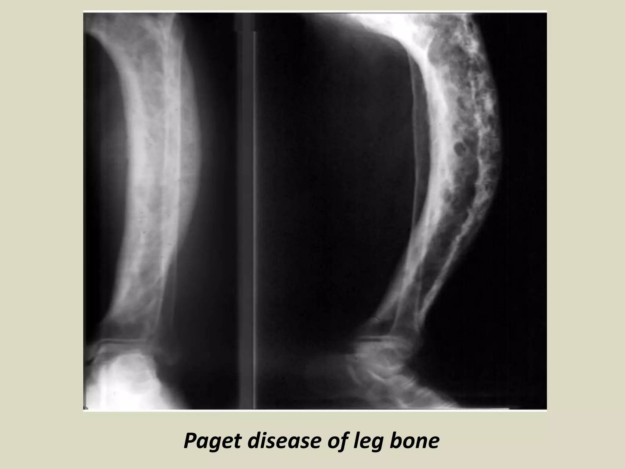 Paget disease of leg bone
 
