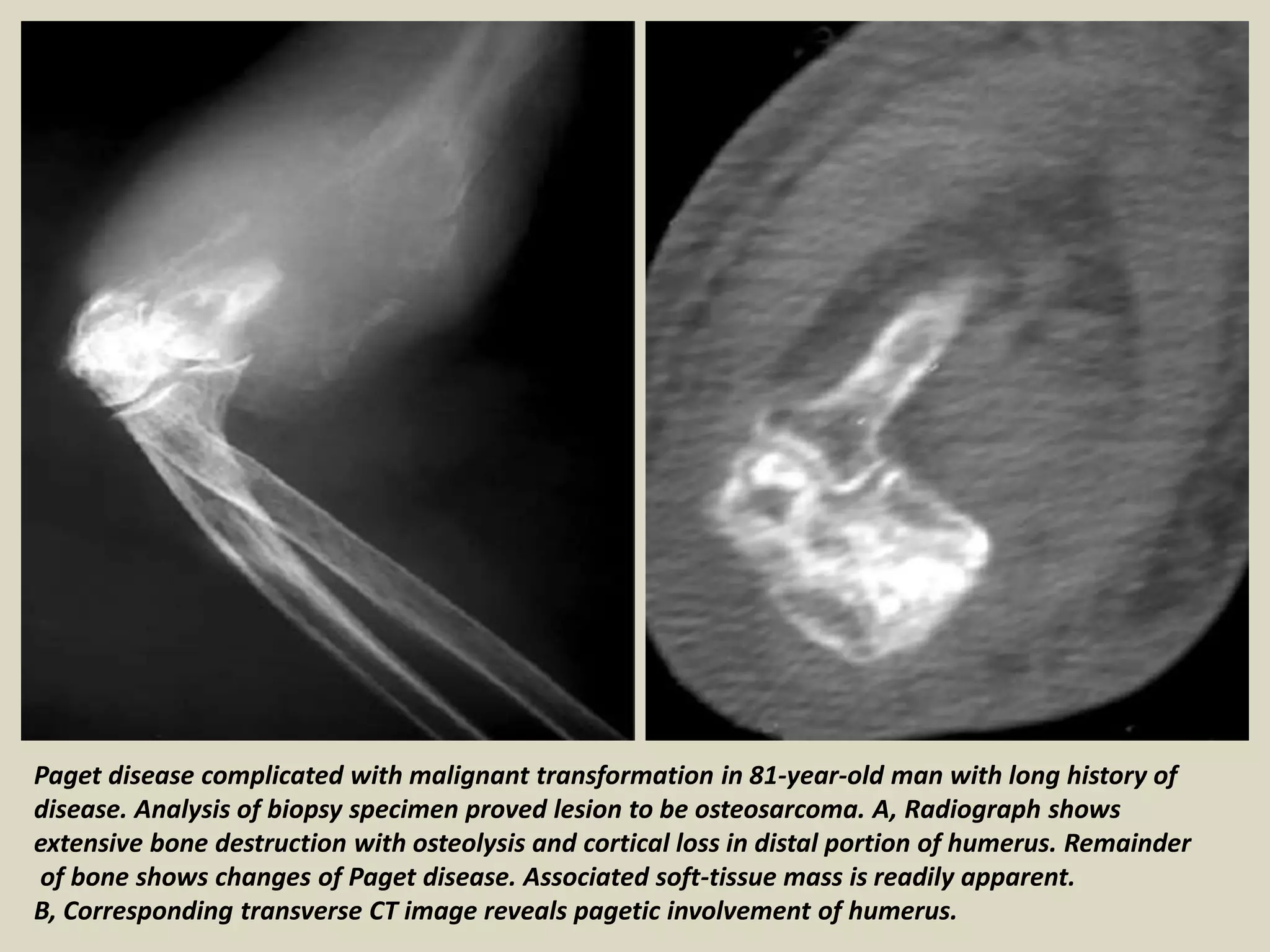 Paget disease complicated with malignant transformation in 81-year-old man with long history of
disease. Analysis of biopsy specimen proved lesion to be osteosarcoma. A, Radiograph shows
extensive bone destruction with osteolysis and cortical loss in distal portion of humerus. Remainder
of bone shows changes of Paget disease. Associated soft-tissue mass is readily apparent.
B, Corresponding transverse CT image reveals pagetic involvement of humerus.
 