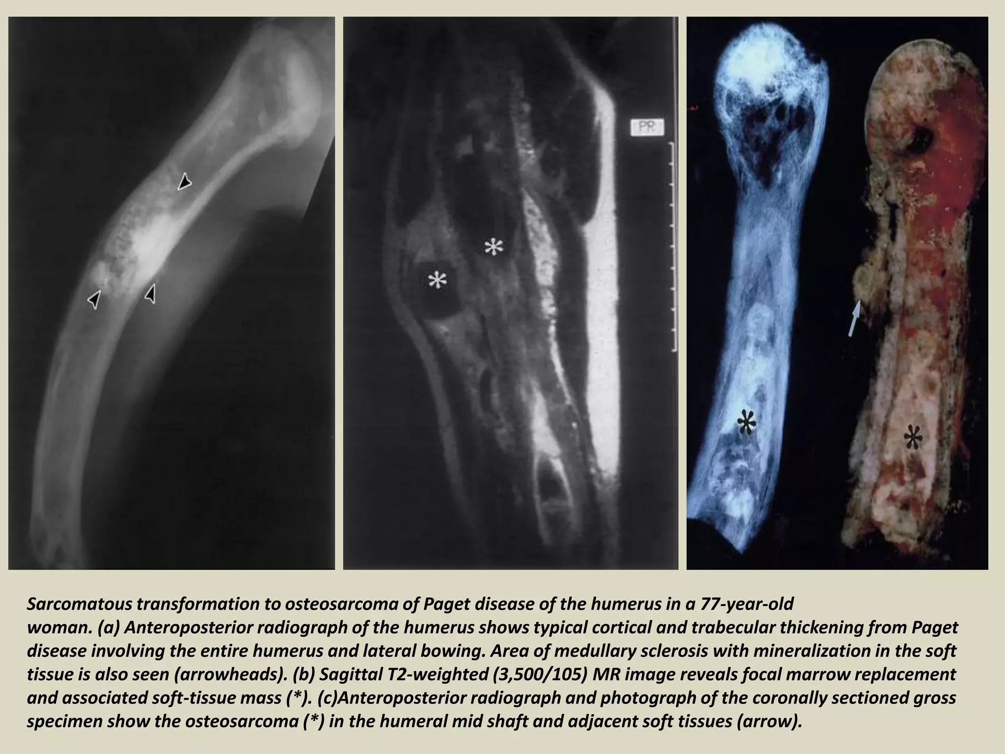 Sarcomatous transformation to osteosarcoma of Paget disease of the humerus in a 77-year-old
woman. (a) Anteroposterior radiograph of the humerus shows typical cortical and trabecular thickening from Paget
disease involving the entire humerus and lateral bowing. Area of medullary sclerosis with mineralization in the soft
tissue is also seen (arrowheads). (b) Sagittal T2-weighted (3,500/105) MR image reveals focal marrow replacement
and associated soft-tissue mass (*). (c)Anteroposterior radiograph and photograph of the coronally sectioned gross
specimen show the osteosarcoma (*) in the humeral mid shaft and adjacent soft tissues (arrow).
 