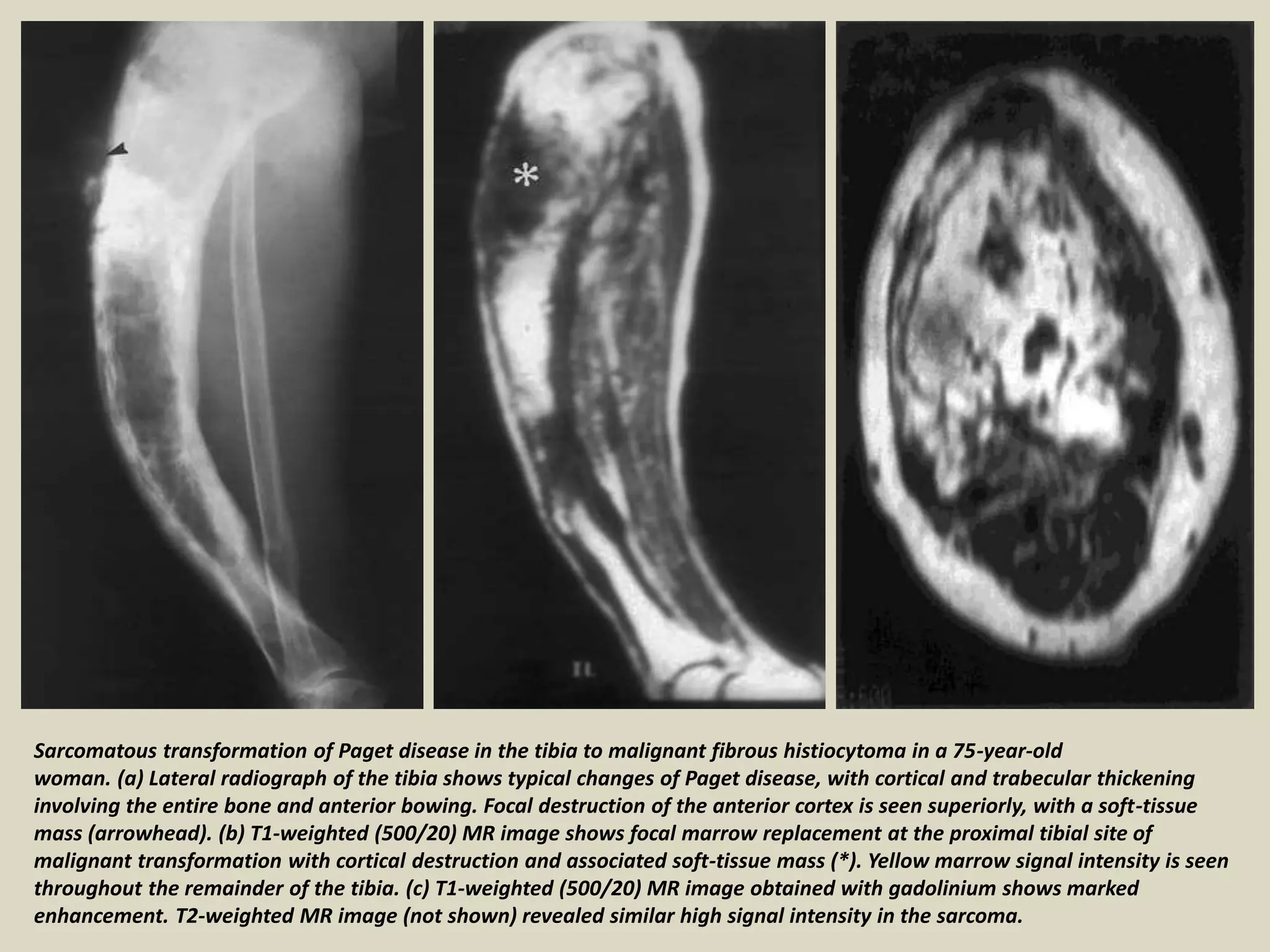 Sarcomatous transformation of Paget disease in the tibia to malignant fibrous histiocytoma in a 75-year-old
woman. (a) Lateral radiograph of the tibia shows typical changes of Paget disease, with cortical and trabecular thickening
involving the entire bone and anterior bowing. Focal destruction of the anterior cortex is seen superiorly, with a soft-tissue
mass (arrowhead). (b) T1-weighted (500/20) MR image shows focal marrow replacement at the proximal tibial site of
malignant transformation with cortical destruction and associated soft-tissue mass (*). Yellow marrow signal intensity is seen
throughout the remainder of the tibia. (c) T1-weighted (500/20) MR image obtained with gadolinium shows marked
enhancement. T2-weighted MR image (not shown) revealed similar high signal intensity in the sarcoma.
 