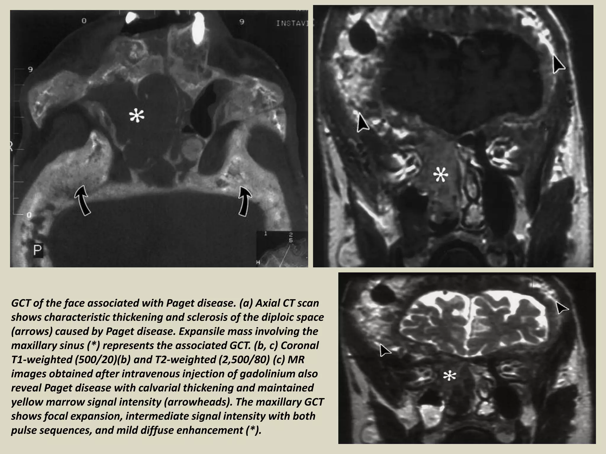 GCT of the face associated with Paget disease. (a) Axial CT scan
shows characteristic thickening and sclerosis of the diploic space
(arrows) caused by Paget disease. Expansile mass involving the
maxillary sinus (*) represents the associated GCT. (b, c) Coronal
T1-weighted (500/20)(b) and T2-weighted (2,500/80) (c) MR
images obtained after intravenous injection of gadolinium also
reveal Paget disease with calvarial thickening and maintained
yellow marrow signal intensity (arrowheads). The maxillary GCT
shows focal expansion, intermediate signal intensity with both
pulse sequences, and mild diffuse enhancement (*).
 