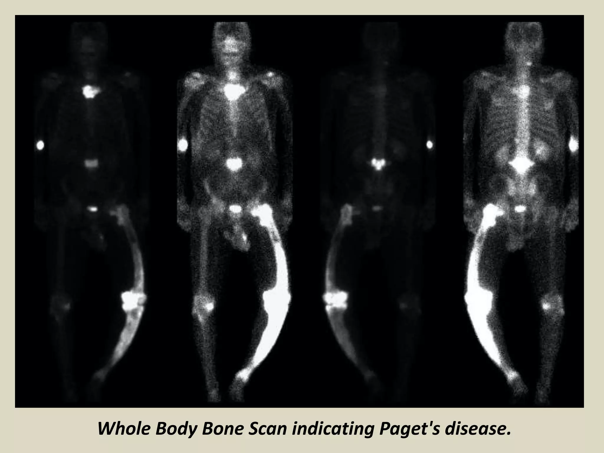 Whole Body Bone Scan indicating Paget's disease.
 